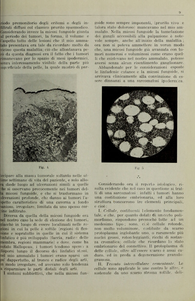 riodo premonitorio degli eritemi e degli in- filtrati diffusi col classico prurito spasmodico. Considerando invece la micosi fungoide giunta al periodo dei tumori, la forma, il volume e l’aspetto tutto delle lesioni che il mio amma- lato presentava era tale da ricordare molto da vicino questa malattia; ciò che allontanava pe- rò da questa diagnosi era il fatto che i tumori rimanevano per lo spazio di mesi ipodermici, -senza interessamento visibile della parte più superficiale della pelle, la quale mostrò di par- Fig. ì. teeipare alla massa tumorale soltanto nelle ul- time settimane di vita del paziente, e solo allo- ra diede luogo ad ulcerazioni simili a quelle ■he si osservano precocemente nei tumori del- la micosi fungoide, e che si trasformano in ulcerazioni profonde, che danno ai tumori l'a- spetto caratteristico di una caverna a fondo !sanioso, irregolare, limitata da uno spesso cer- cine infiltrato. Diversa da quella della micosi fungoide era [nel nostro caso la sede di elezione dei tumori, (giacché in luogo di essere localizzati nelle re- gioni in cui la pelle è sottile (regioni di fles- sione e sopratutto in quelle in cui il sistema linfatico è più sviluppato (faccia, radice delle membra, regioni mammarie) e dove, come ha notato Hallopeau, i tumori tendono spess ) a disporsi lungo il decorso dei linfatici stessi, nel mio ammalato i tumori erano sparsi un po’ dappertutto, al tronco e radice degli arti, in modo irregolare, ed avevano solo tendenza a risparmiare le parti distali degli arti. I sintomi subbiettivi, che nella micosi fun- goide sono sempre imponenti, (prurito vivo e talora stato doloroso) mancavano nel mio am- malato. Nella micosi fungoide la tumefazione dei gangli accessibili alla palpazione è note- vole sempre, anche all inizio della malattia ; ora non si poteva ammettere in verun modo che, una micosi fungoide già avanzata con tu- mori numerosi e voluminosi come erano quel- li che esistevano nel nostro ammalato, potesse aversi senza alcun risentimento ganglionare. Abbandonate per le considerazioni esposte le linfadenie cutanee e la micosi fungoide, si arrivava clinicamente alla convinzione di es- sere dinnanzi a una sarcomatosi ipodermica. Fig 5 h * Considerando ora il reperto istologico, ri- sulta evidente che nel caso in questione si trat- ti di una sarcomatosi : infatti i tumori hanno una costituzione embrionaria, ed alla loro struttura concorrono tre elementi principali, e cioè : I. Cellule, costituenti 1 elemento fondamen- tale, e che, per quanto dotate di un certo poli- morfismo, rispondono pressoché tutte ad un medesimo tipo ; sono, cioè cellule rotonde, non molto voluminose, costituite da scarso protoplasma inglobante uno, o raramente più nuclei grossi, rotondeggianti, ricchi di sostan- za cromatica; cellule che ricordano lo stato embrionario del connettivo. 11 protoplasma di dette cellule, oltre all'essere scarso è assai ca- duco, ed in preda a degenerazione granulo- grassosa . II. Tessuto intercellulare cementante. Le cellule sono applicate le une contro le altre, e sostenute da uno scarso stroma sottile, deli-