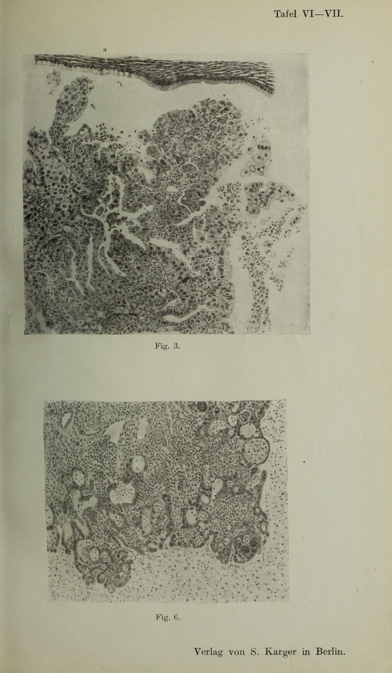 Tafel VI—VII. ''mfm Fig. G. Fig. 3. Verlag von S. Karger in Berlin.