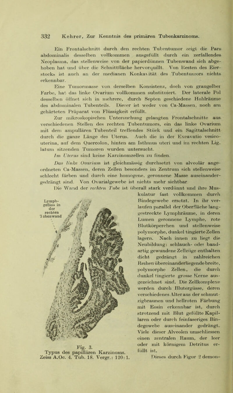 Ein Frontalschnitt durch den rechten Tubentumor zeigt die Pars abdominalis desselben vollkommen ausgefüllt durch ein zerfallendes Neoplasma, das stellenweise von der papierdünnen Tubenwand sich abge- hoben hat und über die Schnittfläche her vor quillt. Von Kesten des Eier- stocks ist auch an der medianen Konkav ität des Tubentumors nichts erkennbar. Eine Tumormasse von derselben Konsistenz, doch von graugelbei Farbe, hat das linke Ovarium vollkommen substituiert. Der laterale Pol desselben öffnet sich in mehrere, durch Septen geschiedene Hohlräume des abdominalen Tubenteils. Dieser ist weder von Ca-Massen, noch am gehärteten Präparat von Flüssigkeit erfüllt. Zur mikroskopischen Untersuchung gelangten Frontalschnitte aus verschiedenen Stellen des rechten Tubentumors, ein das linke Ovarium mit dem ampullären Tubenteil treffendes Stück und ein Sagittalschnitt durch die ganze Länge des Uterus. Auch die in der Excavatio vesico- uterina, auf dem Quercolon, hinten am Isthmus uteri und im rechten Lig. latum sitzenden Tumoren wurden untersucht. Im Uterus sind keine Karzinomzellen zu finden. Das linke Ovarium ist gleichmässig durchsetzt von alveolär ange- ordneten Ca-Massen, deren Zellen besonders im Zentrum sich stellenweise schlecht färben und durch eine homogene, geronnene Masse auseinander- gedrängt sind. Von Ovarialgewebe ist nichts mehr sichtbar. Die Wand der rechten Tube ist überall stark verdünnt und ihre Mus- kulatur fast vollkommen durch Bindegewebe ersetzt. In ihr ver- laufen parallel der Oberfläche lang- gestreckte Lymphräume, in deren Lumen geronnene Lymphe, rote Blutkörperchen und stellenweise polymorphe, dunkel tingierte Zellen lagern. Nach innen zu liegt die Neubildung: schlauch- odet band- artig gewundene Zellziige enthalten dicht gedrängt in zahlreichen Reihen übereinanderliegende breite, polymorphe Zellen, die durch dunkel tingierte grosse Kerne aus- gezeichnet sind. Die Zellkomplexe werden durch Blutergüsse, deren verschiedenes Alter aus der schmut- zigbraunen und hellroten Färbung mit Eosin erkennbar ist, durch strotzend mit Blut gefüllte Kapil- laren oder durch feinfaseriges Bin- degewebe auseinander gedrängt. Viele dieser Alveolen umschliessen einen zentralen Raum, der leer oder mit körnigem Detritus er- füllt ist. Dieses durch Figur 2 demon- Fig. 3. Typus des papillären Karzinoms. Zeiss A.Oc. 4. Tub. 18. Vergr.: 120:1.