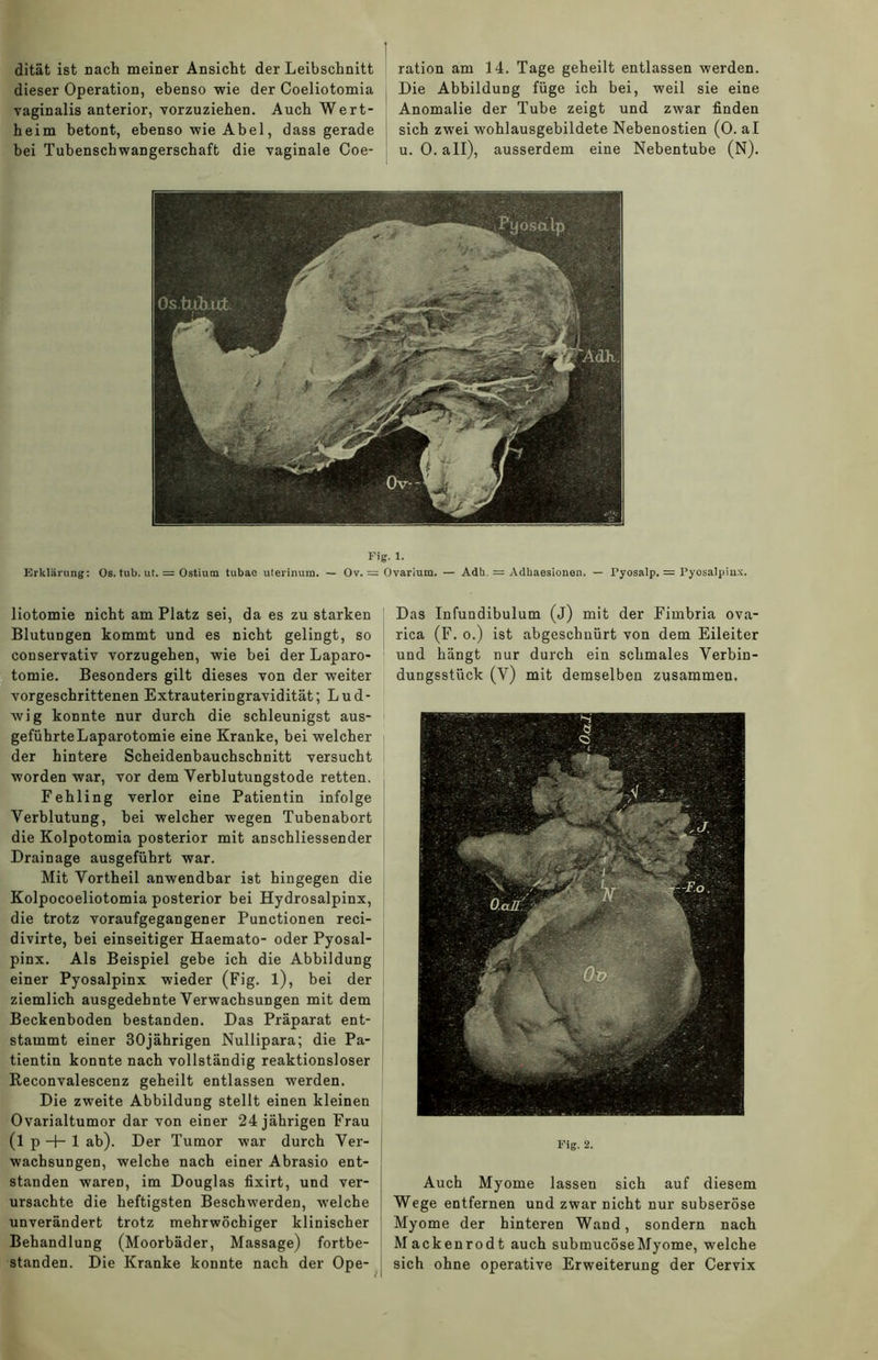 dität ist nach meiner Ansicht der Leibschnitt ration am 14. Tage geheilt entlassen werden, dieser Operation, ebenso wie der Coeliotomia Die Abbildung füge ich bei, weil sie eine vaginalis anterior, vorzuziehen. Auch Wert- Anomalie der Tube zeigt und zwar finden heim betont, ebenso wie Abel, dass gerade sich zwei wohlausgebildete Nebenostien (0. al bei Tubenschwangerschaft die vaginale Coe- u. 0. all), ausserdem eine Nebentube (N). Fig. 1. Erklärung: Os. tub. ut. = Ostium tubae uterinum. — Ov. = Ovarium. — Adh. = Adhaesionen. — l’yosalp. = Pyosalpiux. liotomie nicht am Platz sei, da es zu starken Blutungen kommt und es nicht gelingt, so conservativ vorzugehen, wie bei der Laparo- tomie. Besonders gilt dieses von der weiter vorgeschrittenen Extrauteringravidität; Lud- wig konnte nur durch die schleunigst aus- geführte Laparotomie eine Kranke, bei welcher der hintere Scheidenbauchschnitt versucht worden war, vor dem Verblutungstode retten. Fehling verlor eine Patientin infolge Verblutung, bei welcher wegen Tubenabort die Kolpotomia posterior mit anschliessender Drainage ausgeführt war. Mit Vortheil anwendbar ist hingegen die Kolpocoeliotomia posterior bei Hydrosalpinx, die trotz voraufgegangener Punctionen reci- divirte, bei einseitiger Haemato- oder Pyosal- pinx. Als Beispiel gebe ich die Abbildung einer Pyosalpinx wieder (Fig. l), bei der ziemlich ausgedehnte Verwachsungen mit dem Beckenboden bestanden. Das Präparat ent- stammt einer 30jährigen Nullipara; die Pa- tientin konnte nach vollständig reaktionsloser Reconvalescenz geheilt entlassen werden. Die zweite Abbildung stellt einen kleinen Ovarialtumor dar von einer 24 jährigen Frau (l p + 1 ab). Der Tumor war durch Ver- wachsungen, welche nach einer Abrasio ent- standen waren, im Douglas fixirt, und ver- ursachte die heftigsten Beschwerden, welche unverändert trotz mehrwöchiger klinischer Behandlung (Moorbäder, Massage) fortbe- standen. Die Kranke konnte nach der Ope- Das Infundibulum (j) mit der Fimbria ova- rica (F. o.) ist abgeschnürt von dem Eileiter und hängt nur durch ein schmales Verbin- dungsstück (V) mit demselben zusammen. Fig. 2. Auch Myome lassen sich auf diesem Wege entfernen und zwar nicht nur subseröse Myome der hinteren Wand, sondern nach Mackenrodt auch submucöseMyome, welche [ sich ohne operative Erweiterung der Cervix