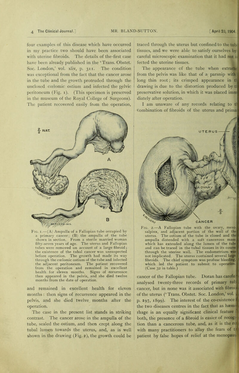 Fig. i.—(A) Ampulla of a Fallopian tube occupied by a primary cancer; (B) the ampulla of the tube shown in section. From a sterile married woman fifty-seven years of age. The uterus and Fallopian tubes were removed on account of a large fibroid; the existence of the tubal cancer was unsuspected before operation. The growth had made its way through the coelomic ostium of the tube and infected the adjacent peritoneum. The patient recovered from the operation and remained in excellent health for eleven months. Signs of recurrence then appeared in the pelvis, and she died twelve months from the date of operation. and remained in excellent health for eleven months : then signs of recurrence appeared in the pelvis, and she died twelve months after the operation. The case in the present list stands in striking contrast. The cancer arose in the ampulla of the tube, sealed the ostium, and then crept along the tubal lumen towards the uterus, and, as is well shown in the drawing (Fig. 2), the growth could be Fig. 2.—A Fallopian tube with the ovary, meso- salpinx, and adjacent portion of the wall of tht uterus. The ostium of the tube is closed and the ampulla distended with a soft cancerous mass; which has extended along the lumen of the tube and can be traced in the tubal tissues in its course through the uterine wall. The endometrium was not implicated. The uterus contained several large! fibroids. The chief symptom was profuse bleeding,! which led the patient to submit to operation j (Case 32 in table.) cancer of the Fallopian tube. Doran has careful analysed twenty-three records of primary tuti cancer, but in none was it associated with fibrois of the uterus (‘Trans. Obstet. Soc. London,’vol. ; p. 197, 1899). The interest of the co-existence the two diseases centres in the fact that as haeml rhage is an equally significant clinical feature p both, the presence of a fibroid is easier of recog r? tion than a cancerous tube, and, as it is the riel with many practitioners to allay the fears of t|:} patient by false hopes of relief at the menopau > ■ four examples of this disease which have occurred in my practice two should have been associated with uterine fibroids. The details of the-first case have been already published in the ‘Trans. Obstet. Soc. London,’ vol. xliv, p. 311. The condition was exceptional from the fact that the cancer arose in the tube and the growth protruded through the unclosed coelomic ostium and infected the pelvic peritoneum (Fig. 1). (This specimen is preserved in the museum of the Royal College of Surgeons). The patient recovered easily from the operation, traced through the uterus but confined to the tub, tissues, and we were able to satisfy ourselves by |j careful microscopic examination that it had not ill fected the uterine tissues. The appearance of the tube when extracte from the pelvis was like that of a parsnip with long thin root; its crimped appearance in tl drawing is due to the distortion produced by tl preservative solution, in which it was placed imm diately after operation. I am unaware of any records relating to tl