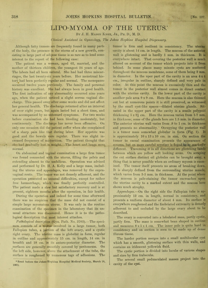 LIPO-MYOMA OF THE UTERUS/ By J. H. Mason Knox, Jr., Ph. D., M. D. Clinical Assistant in Gynecology, The Johns Hopkins Hospital Dispensary. Although fatty tumors are frequently found in many parts of the body, the presence in the uterus of a new growth, con- sisting in large part of adipose tissue is so rare as to lend some interest to the report of the following case: The patient was a woman, aged 62, married, and the mother of thirteen children, the youngest 24 years of age. The labors had all been natural. She had had three miscar- riages, the last twenty-six years before. Her menstrual his- tory had been perfectly regular and normal. The menopause occurred twelve years previously. The family and personal history was excellent. She had always been in good health. The first indication of any abnormality occurred nine years ago, when the patient noticed a slight serous vaginal dis- charge. This passed away after some weeks and did not affect her general health. The discharge returned after an interval of over eight years, but, again lasted but a short time, and was accompanied by no untoward symptoms. For two weeks before examination she had been bleeding moderately, but continuously. The discharge has never been offensive. On only one occasion did the patient suffer when she complained of a sharp pain like that during labor. Her appetite was good and the bowels were regular. There was slight in- creased frequency of micturition. The patient thought that eke had gradually lost in weight. Tim heart and lungs were, normal. On abdominal and vaginal examination a large firm tumor was found connected with the uterus, filling the pelvis and extending almost to the umbilicus. Operation was advised and performed by Dr. H. A. Kelly and a large mass, includ- ing the uterus and appendages, was removed by the supra- vaginal route. The tumor was not densely adherent, and the operation presented no unusual difficulties, except for rather free haemorrhage, which was finally perfectly controlled. The patient made a slow but satisfactory recovery and is at present, eighteen months after the operation, in fair health. During the operation and indeed for some time afterward there was no suspicion that the mass did not consist of a simple large myomatous uterus. It was only in the routine examination of the specimen in the laboratory that its un- usual structure was discovered. Hence it is to the patho- logical description that most interest attaches. Pathological description (Gyn. Path. No. 3703).—The speci- men consists of a uUrus involved in a large tumor, both Fallopian tubes, a portion of the left ovary, and a cystic right ovary. The uterine mass is globular in form, regular in outline and approximately 15 cm. in length, 14 cm. in breadth and 18 cm. in its antero-posterior diameter. The surfaces are generally smoothly covered by peritoneum. On the left side, however, above the attachment of the tube, the surface is roughened by numerous tags of adhesions. The *Read before the Johns Hopkins Hospital Medical Society, March 18, 1901. tumor is firm and resilient in consistency. The uterine cavity is about 14 cm. in length. The mucosa of the anterior wall is glistening and is hardly 1 mm. in thickness. It is everywhere intact. That covering the posterior wall is much altered on account of the tumor which projects into it from behind. In some places many minute cysts are scattered throughout the mucous membrane, some of them being 2 mm. in diameter. In the uper part of the cavity is an area 4 x4 cm., irregular in outline, sharply defined and very pale in color. At this point the mucosa is excessively thin and the tumor in the posterior wall almost comes in direct contact with the uterine cavity. In the lower part of the cavity is another pale area 9x9 cm. Here the mucosa is also thinned out but at numerous points it is still preserved, as witnessed by the small cyst-like spaces—dilated uterine glands. Sit- uated in the upper part of the cavity is a sessile polypoid thickening 5 x 2 J cm. Here the mucosa varies from 1-7 mm. in thickness; some of the glands here are 1.5 mm. in diameter. The anterior uterine wall varies from .8 to 1 cm. in thickness and presents no abnormality. Occupying the posterior wall is a tumor mass somewhat globular in form (Fig. 1). It is approximately 10 x 13 x 10 cm. in size. On section the tumor to casual examination presents the appearance of mvoma. but on more careful scrutiny is found tu be markedly different. Traversing it in all directions are glistening bands between which are yellow soft looking areas. On scraping the cut surface distinct oil globrdes can be brought away, a thing that is never possible when an ordinary myoma is exam- ined. The tumor itself presents no areas of breaking down. It is sharply defined from the surrounding uterine muscle, which varies from 3-5 mm. in thickness. At the point where the mucosa is pale-staining the tumor encroaches upon the uterine cavity to a marked extent and the mucosa here shows much atrophy. Appendages.—On the right side the Fallopian tube is ap- proximately 12 cm. in length, normal in consistency, and presents a uniform diameter of about 4 mm. Its surface is everywhere roughened and the fimbriated extremity is densely adherent to and occluded by the large ovary about to be described. The ovary is converted into a tabulated mass, partly cystic, partly firm. The mass is somewhat bean shaped in outline and measures 8x5x4 cm. The inner pole is quite hard in consistency and on section is seen to be made up of dense fibrous tissue. The harder portion merges into a small multilocular cyst which has a smooth, glistening surface with thin walls, and contains an iridescent yellowish fluid. The cystic portion is divided into loculae of various shapes and sizes by firm trabeculae. The several small pedunculated masses project into the cavity of the cyst.