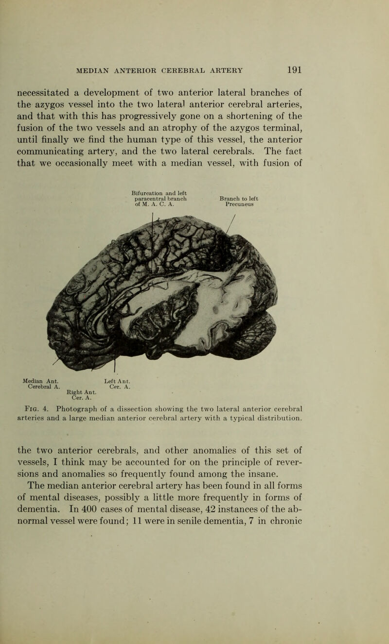 necessitated a development of two anterior lateral branches of the azygos vessel into the two lateral anterior cerebral arteries, and that with this has progressively gone on a shortening of the fusion of the two vessels and an atrophy of the azygos terminal, until finally we find the human type of this vessel, the anterior communicating artery, and the two lateral cerebrals. The fact that we occasionally meet with a median vessel, with fusion of Bifurcation and left paracentral branch Branch to left of M. A. C. A. Precuneus Median Ant. Left Ant. Cerebral A. Cer. A. Right Ant. Cer. A. Fig. 4. Photograph of a dissection showing the two lateral anterior cerebral arteries and a large median anterior cerebral artery with a typical distribution. the two anterior cerebrals, and other anomalies of this set of vessels, I think may be accounted for on the principle of rever- sions and anomalies so frequently found among the insane. The median anterior cerebral artery has been found in all forms of mental diseases, possibly a little more frequently in forms of dementia. In 400 cases of mental disease, 42 instances of the ab-