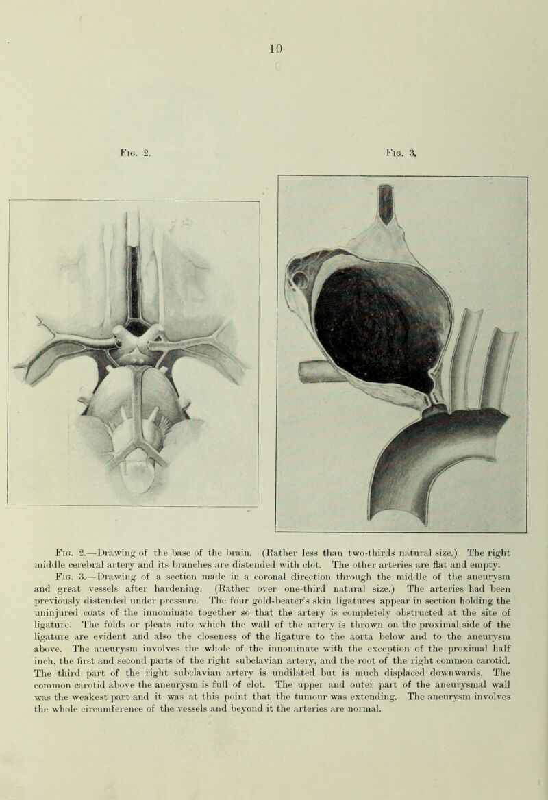 Fig. 2. Fig. 3. Fig. 2.—Drawing of the base of the brain. (Rather less than two-thirds natural size.) The right middle cerebral artery and its branches are distended with clot. The other arteries are flat and empty. Fig. 3.—Drawing of a section made in a coronal direction through the middle of the aneurysm and great vessels after hardening. (Rather over one-third natural size.) The arteries had been previously distended under pressure. The four gold-beater’s skin ligatures appear in section holding the uninjured coats of the innominate together so that the artery is completely obstructed at the site of ligature. The folds or pleats into which the wall of the artery is thrown on the proximal side of the ligature are evident and also the closeness of the ligature to the aorta below and to the aneurysm above. The aneurysm involves the whole of the innominate with the exception of the proximal half inch, the first and second parts of the right subclavian artery, and the root of the right common carotid. The third part of the right subclavian artery is undilated but is much displaced downwards. The common carotid above the aneurysm is full of clot. The upper and outer part of the aneurysmal wall was the weakest part and it was at this point that the tumour was extending. The aneurysm involves the whole circumference of the vessels and beyond it the arteries are normal.