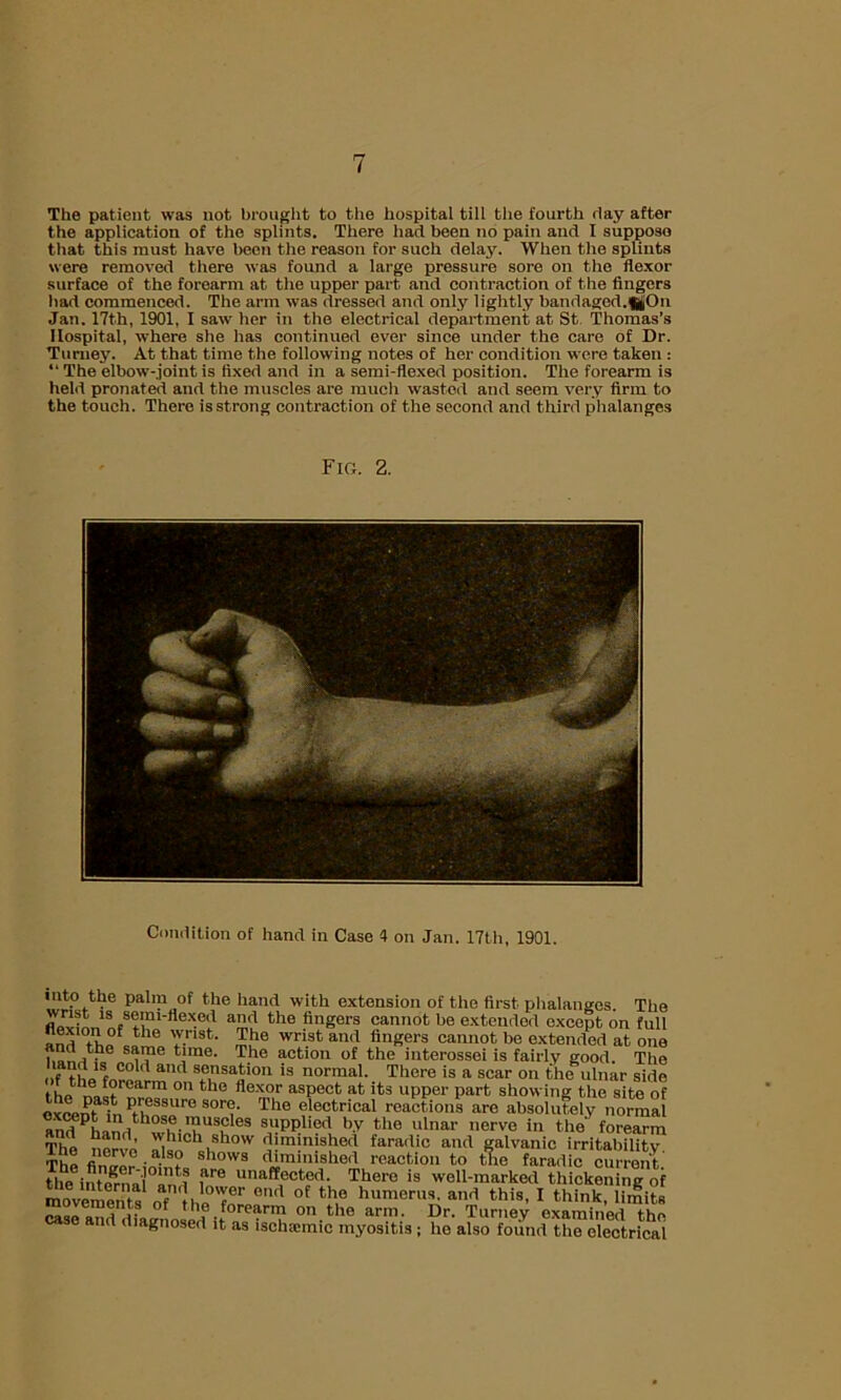 The patient was not brought to the hospital till the fourth day after the application of the splints. There had been no pain and I suppose that this must have been the reason for such delay. When the splints were removed there was found a large pressure sore on the flexor surface of the forearm at the upper part and contraction of the fingers had commenced. The arm was dressed and only lightly bandaged.fjOn Jan. 17th, 1901, I saw her in the electrical department at St Thomas’s Hospital, where she has continued ever since under the care of Dr. Turney. At that time the following notes of her condition were taken : “ The elbow-.joint is fixed and in a semi-flexed position. The forearm is held pronated and the muscles are much wasted and seem very firm to the touch. There is strong contraction of the second and third phalanges Fig. 2. Condition of hand in Case 4 on Jan. 17th, 1901. into the palm of the hand with extension of the first phalanges. The wrist is semi-flexed and the fingers cannot be extended except on full and tv,ofJhe Y.nst’ £,he wrist and Angers cannot be extended at one same tune. The action of the interossei is fairly good. The of the fnrelrmd s.°.nsa£iou is normal. There is a scar on the ulnar side t hn no forearm on the flexor aspect at its upper part showing the site of oxcent in PH?nS«re SOr<T The electrical reactions are absolutely normal andPL,‘, oe-'?USlcIes snPP'ied by the ulnar nerve in the forearm The nerve '\ llcl,sllow diminished faradic and galvanic irritability The finver in m shows ^nished reaction to &e faradic current.' tho i! nm„ ,are unaffected. There is well-marked thickening of movements of , 6nrt ot th,e humerus, and this, I think, lS Msrand dinannll f-f eanV 011 the ann• Dr. Turney examined the case and diagnosed it as ischaimic myositis ; he also found the electrical