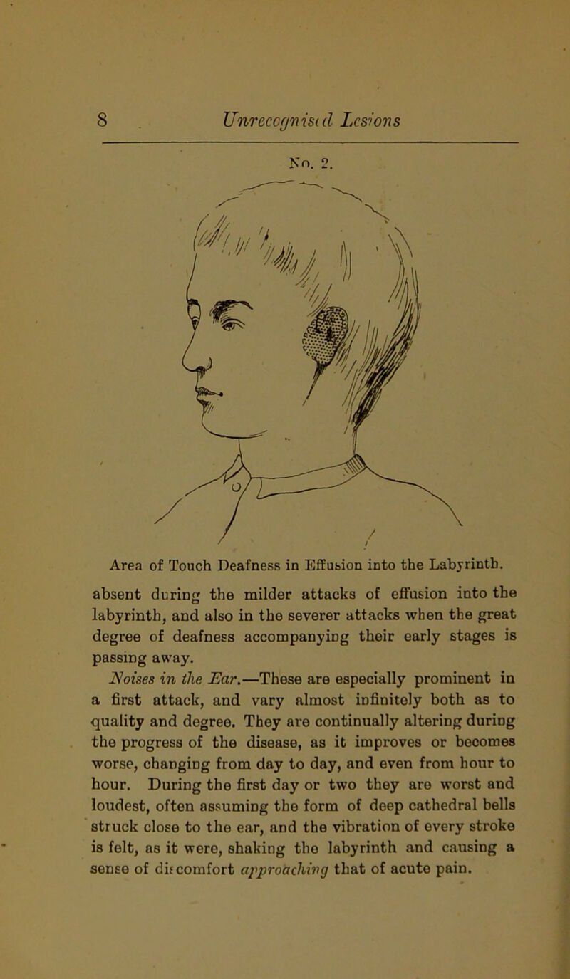 No. 2. Area of Touch Deafness in Effusion into the Labyrinth. absent during the milder attacks of effusion into the labyrinth, and also in the severer attacks when the great degree of deafness accompanying their early stages is passing away. Noises in the Ear.—These are especially prominent in a first attack, and vary almost infinitely both as to quality and degree. They are continually altering during the progress of the disease, as it improves or becomes worse, changing from day to day, and even from hour to hour. During the first day or two they are worst and loudest, often assuming the form of deep cathedral bells struck close to the ear, and the vibration of every stroke is felt, as it were, shaking tho labyrinth and causing a sense of dir comfort approaching that of acute pain.