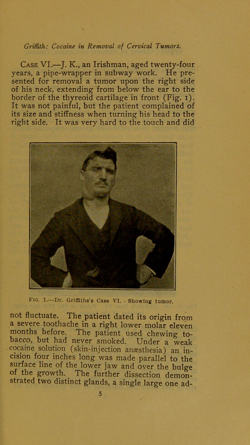 Case VI.—J. K., an Irishman, aged twenty-four years, a pipe-wrapper in subway work. He pre- sented for removal a tumor upon the right side of his neck, extending from below the ear to the border of the thyreoid cartilage in front (Fig. i). It was not painful, but the patient complained of its size and stiffness when turning his head to the right side. It was very hard to the touch and did ®'IG- !•—Ur. Griffiths's Case VI. • Showing tumor. not fluctuate. The.patient dated its origin from a severe toothache in a right lower molar eleven months before. The patient used chewing to- bacco, but had never smoked. Under a weak cocaine solution (skin-injection anaesthesia) an in- cision four inches long was made parallel to the surface line of the lower jaw and over the bulge of the growth.. The further dissection demon- strated two distinct glands, a single large one ad-