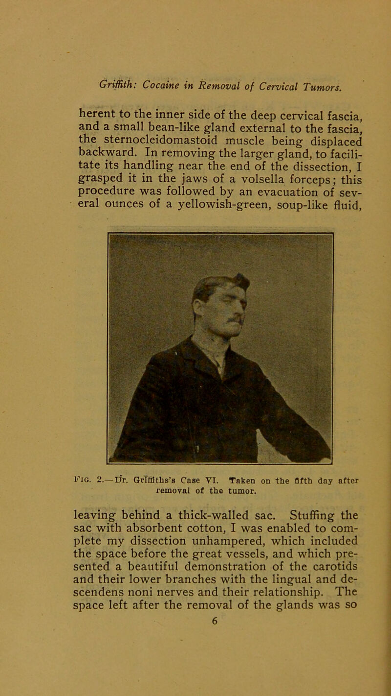 herent to the inner side of the deep cervical fascia, and a small bean-like gland external to the fascia, the sternocleidomastoid muscle being displaced backward. In removing the larger gland, to facili- tate its handling near the end of the dissection, I grasped it in the jaws of a volsella forceps; this procedure was followed by an evacuation of sev- eral ounces of a yellowish-green, soup-like fluid, Fig. 2.— Dr. Griffiths’s Case VI. Taken on the fifth day after removal of the tumor. leaving behind a thick-walled sac. Stuffing the sac with absorbent cotton, I was enabled to com- plete my dissection unhampered, which included the space before the great vessels, and which pre- sented a beautiful demonstration of the carotids and their lower branches with the lingual and de- scendens noni nerves and their relationship. The space left after the removal of the glands was so