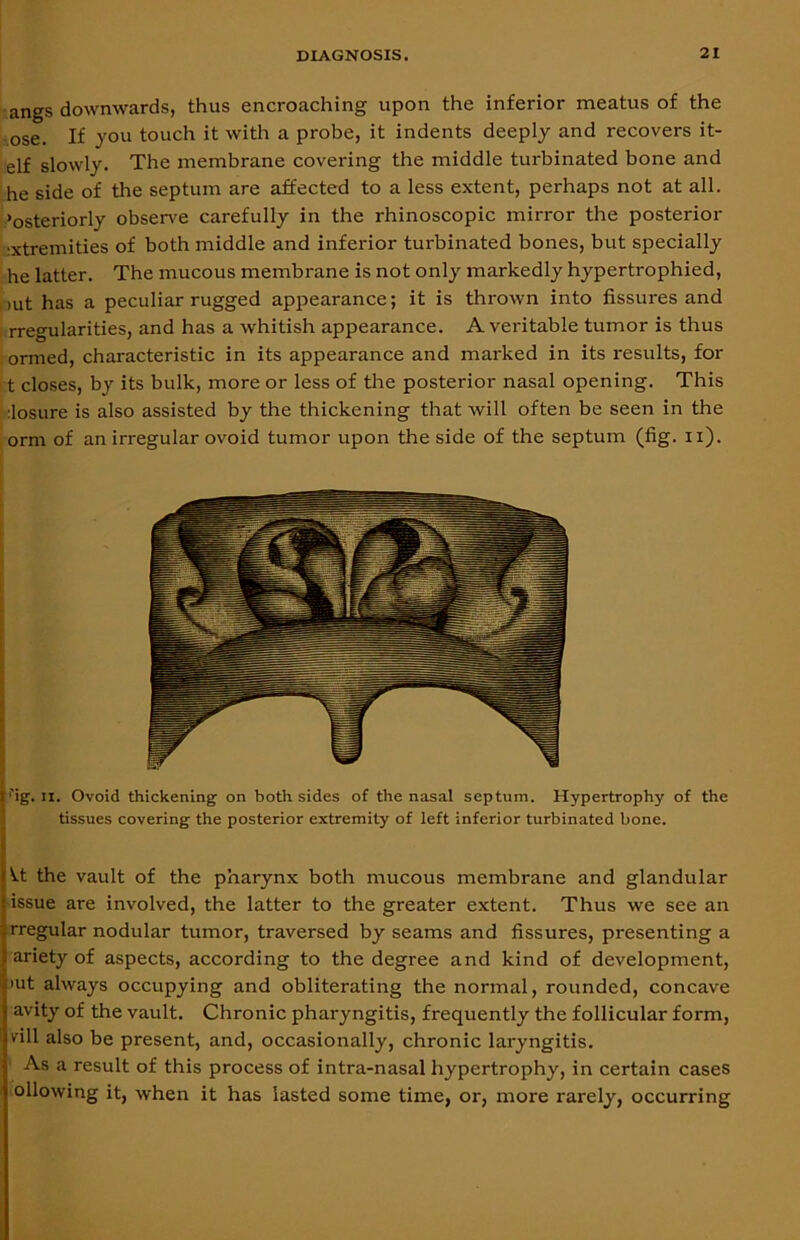 angs downwards, thus encroaching upon the inferior meatus of the ose. If you touch it with a probe, it indents deeply and recovers it- elf slowly. The membrane covering the middle turbinated bone and he side of the septum are affected to a less extent, perhaps not at all. ‘osteriorly observe carefully in the rhinoscopic mirror the posterior :xtreinities of both middle and inferior turbinated bones, but specially he latter. The mucous membrane is not only markedly hypertrophied, mt has a peculiar rugged appearance; it is thrown into fissures and rregularities, and has a whitish appearance. A veritable tumor is thus ormed, characteristic in its appearance and marked in its results, for t closes, by its bulk, more or less of the posterior nasal opening. This ilosure is also assisted by the thickening that will often be seen in the orm of an irregular ovoid tumor upon the side of the septum (fig. n). ''ig. II. Ovoid thickening on both sides of the nasal septum. Hypertrophy of the tissues covering the posterior extremity of left inferior turbinated bone. ^.t the vault of the pharynx both mucous membrane and glandular issue are involved, the latter to the greater extent. Thus we see an rregular nodular tumor, traversed by seams and fissures, presenting a ariety of aspects, according to the degree and kind of development, >ut always occupying and obliterating the normal, rounded, concave avity of the vault. Chronic pharyngitis, frequently the follicular form, vill also be present, and, occasionally, chronic laryngitis. As a result of this process of intra-nasal hypertrophy, in certain cases ollowing it, when it has lasted some time, or, more rarely, occurring