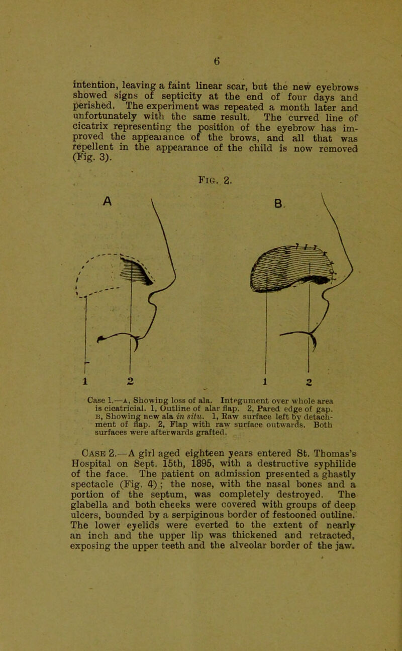 intention, leaving a faint linear scar, but the new eyebrows showed signs of septicity at the end of four days and perished. The experiment was repeated a month later and unfortunately with the same result. The curved line of cicatrix representing the position of the eyebrow has im- proved the appealance of the brows, and all that was repellent in the appearance of the child is now removed (Pig- 3). Fig. 2. 1 2 Case 1.—A, Showing loss of ala. Integument over whole area is cicatricial. 1, Outline of alar flap. 2, Pared edge of gap. B, Showing new ala in situ. 1, Kaw surface left by detach- ment of flap. 2, Flap with raw surface outwards. Both surfaces weie afterwards grafted. Case 2.—A girl aged eighteen years entered St. Thomas’s Hospital on Sept. 15th, 1895, with a destructive syphilide of the face. The patient on admission presented a ghastly spectacle (Fig. 4) ; the nose, with the nasal bones and a portion of tbe septum, was completely destroyed. The glabella and both cheeks were covered with groups of deep ulcers, bounded by a serpiginous border of festooned outline. The lower eyelids were everted to the extent of nearly an inch and the upper lip was thickened and retracted, exposing the upper teeth and the alveolar border of the jaw.