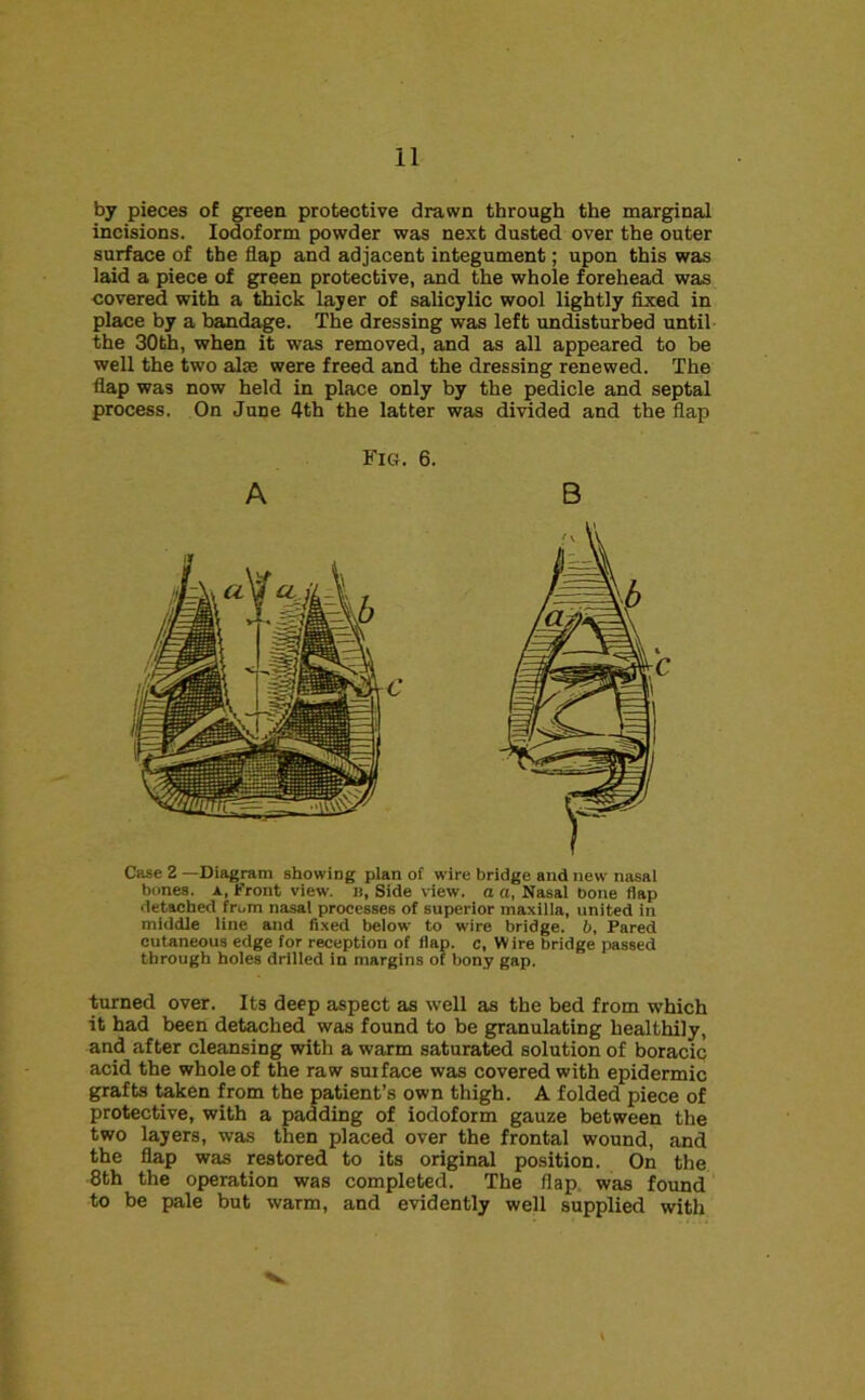 by pieces of green protective drawn through the marginal incisions. Iodoform powder was next dusted over the outer surface of the flap and adjacent integument; upon this was laid a piece of green protective, and the whole forehead was covered with a thick layer of salicylic wool lightly fixed in place by a bandage. The dressing was left undisturbed until the 30th, when it was removed, and as all appeared to be well the two alse were freed and the dressing renewed. The flap was now held in place only by the pedicle and septal process. On June 4th the latter was divided and the flap Fig. 6. A B Case 2 —Diagram showing plan of wire bridge and new nasal bones, a, Front view, n. Side view, a a, Nasal bone flap detached from nasal processes of superior maxilla, united in middle line and fixed below to wire bridge, b, Pared cutaneous edge for reception of flap, c, Wire bridge passed through boles drilled in margins of bony gap. turned over. Its deep aspect as well as the bed from which it had been detached was found to be granulating healthily, and after cleansing with a warm saturated solution of boracic acid the whole of the raw surface was covered with epidermic grafts taken from the patient’s own thigh. A folded piece of protective, with a padding of iodoform gauze between the two layers, was then placed over the frontal wound, and the flap was restored to its original position. On the 8th the operation was completed. The flap, was found to be pale but warm, and evidently well supplied with \