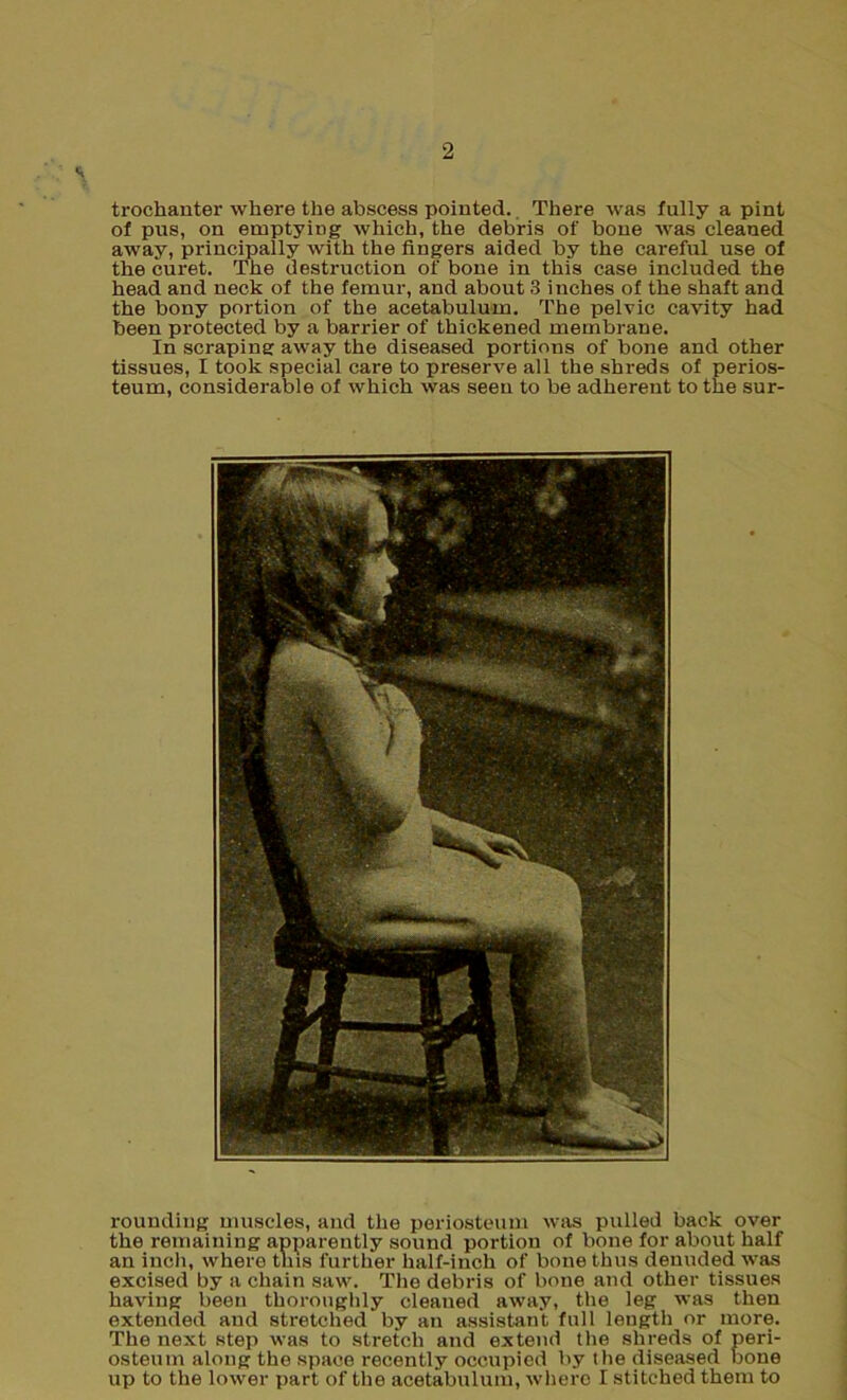 trochanter where the abscess pointed. There was fully a pint of pns, on emptying which, the debris of bone was cleaned away, principally with the fingers aided by the careful use of the curet. The destruction of bone in this case included the head and neck of the femur, and about 3 inches of the shaft and the bony portion of the acetabulum. The pelvic cavity had been protected by a barrier of thickened membrane. In scraping away the diseased portions of bone and other tissues, I took special care to preserve all the shreds of perios- teum, considerable of which was seen to be adherent to the sur- rounding muscles, and the periosteum was pulled back over the remaining apparently sound portion of bone for about half an inch, where this further half-inch of bone thus denuded was excised by a chain saw. The debris of bone and other tissues having been thoroughly cleaned away, the leg was then extended and stretched by an assistant full length or more. The next step was to stretch and extend the shreds of peri- osteum along the space recently occupied by the diseased bone up to the lower part of the acetabulum, where I stitched them to
