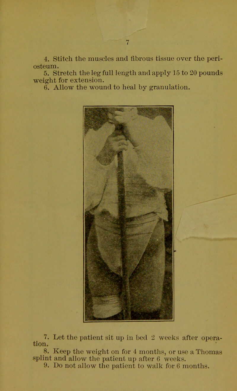 4. Stitch the muscles and fibrous tissue over the peri- osteum. 5. Stretch the leg full length and apply 15 to 20 pounds weight for extension. 6. Allow the wound to heal by granulation. 7. Let the patient sit up in bed 2 weeks after opera- tion. 8. Keep the weight on for 4 months, or use a Thomas splint and allow the patient up after 6 weeks. 9. Do not allow the patient to walk for 6 months.