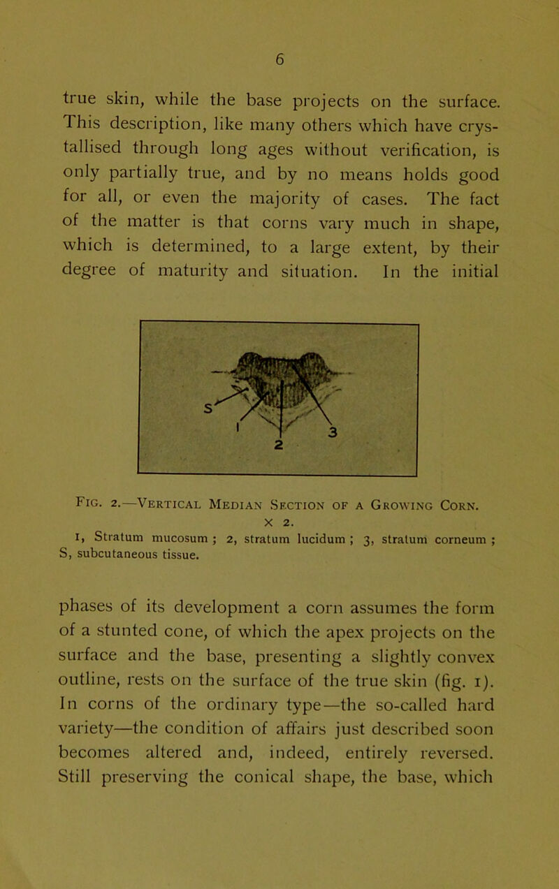 true skin, while the base projects on the surface. This description, like many others which have crys- tallised through long ages without verification, is only partially true, and by no means holds good for all, or even the majority of cases. The fact of the matter is that corns vary much in shape, which is determined, to a large extent, by their degree of maturity and situation. In the initial Fig. 2.—Vertical Median .Section of a Growing Corn. X 2. I, Stratum mucosum ; 2, stratum lucidum ; 3, stratum corneum ; S, subcutaneous tissue. phases of its development a corn assumes the form of a stunted cone, of which the apex projects on the surface and the base, presenting a slightly convex outline, rests on the surface of the true skin (fig. i). In corns of the ordinary type—the so-called hard variety—the condition of affairs just described soon becomes altered and, indeed, entirely reversed. Still preserving the conical shape, the base, which