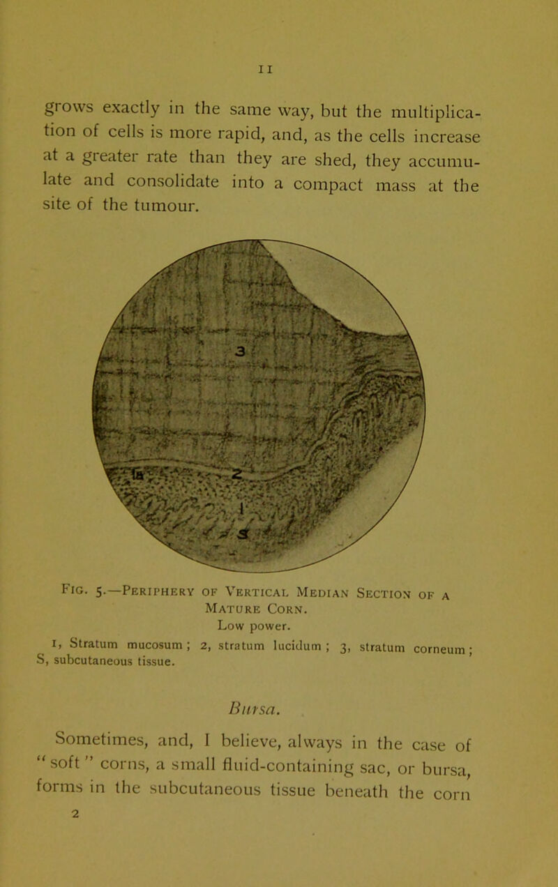 grows exactly in the same way, but the multiplica- tion of cells is more rapid, and, as the cells increase at a gi eater rate than they are shed, they accumu- late and consolidate into a compact mass at the site of the tumour. Fig. S-—Periphery of Vertical Median Section of a Mature Corn. Low power. I, Stratum mucosum ; 2, stratum luciclum ; 3, stratum corneum • S, subcutaneous tissue. Bursa. Sometimes, and, I believe, always in the case of  soft ” corns, a small fluid-containing sac, or bursa, forms in the subcutaneous tissue beneath the corn 2