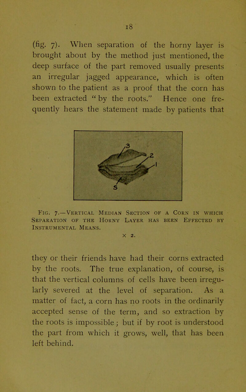 (fig- 7)’ Wlien separation of the horny layer is brought about by the method just mentioned, the deep surface of the part removed usually presents an irregular jagged appearance, which is often shown to the patient as a proof that the corn has been extracted “ by the roots.” Hence one fre- quently hears the statement made by patients that Fig. 7.—Vertical Median Section of a Corn in which Separation of the Hokny Layer has been Effected by Instrumental Means. X 2. they or their friends have had their corns extracted by the roots. The true explanation, of course, is that the vertical columns of cells have been irregu- larly severed at the level of separation. As a matter of fact, a corn has no roots in the ordinarily accepted sense of the term, and so extraction by the roots is impossible; but if by root is understood the part from which it grows, well, that has been left behind.