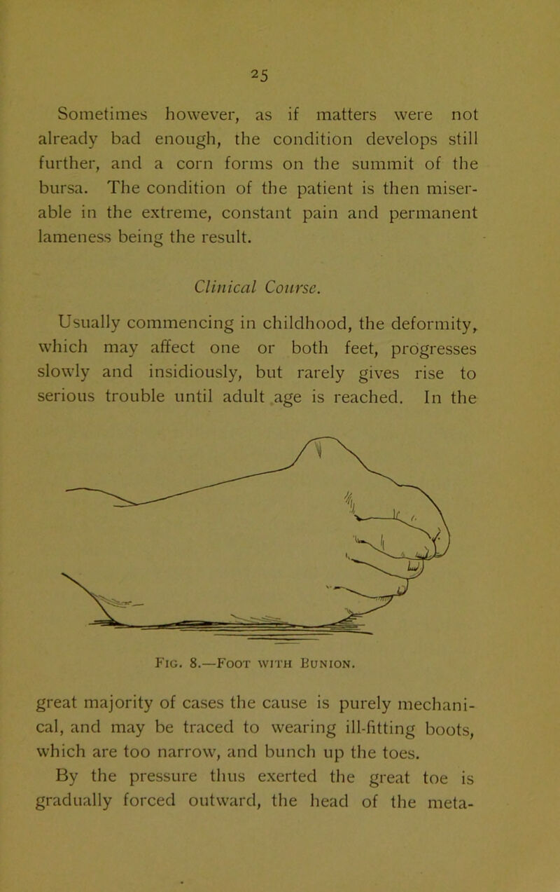 Sometimes however, as if matters were not already bad enough, the condition develops still further, and a corn forms on the summit of the bursa. The condition of the patient is then miser- able in the extreme, constant pain and permanent lameness being the result. Usually commencing in childhood, the deformity, which may affect one or both feet, progresses slowly and insidiously, but rarely gives rise to serious trouble until adult age is reached. In the great majority of cases the cause is purely mechani- cal, and may be traced to wearing ill-fitting boots, which are too narrow, and bunch up the toes. By the pressure thus exerted the great toe is gradually forced outward, the head of the meta- Clinical Course. Fig. 8.—Foot with Bunion.