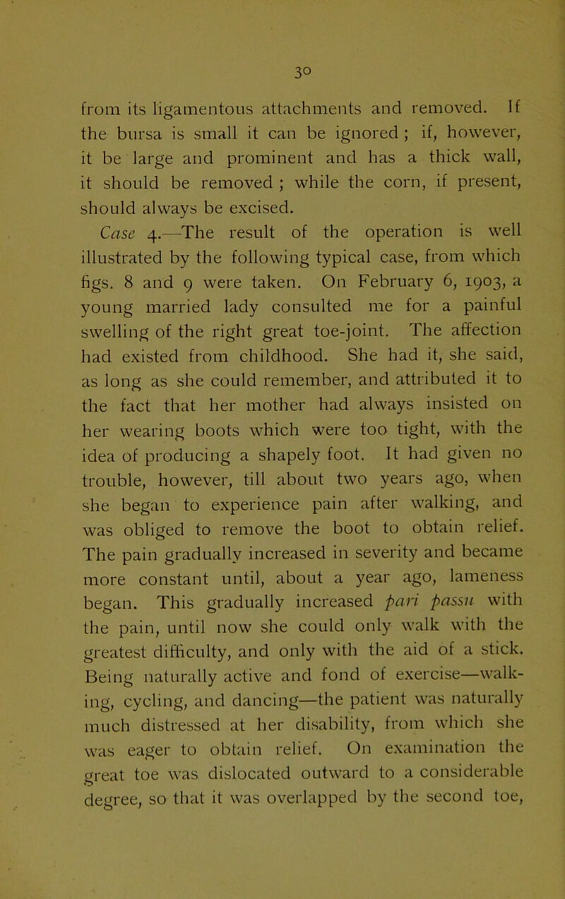 from its ligamentous attachments and removed. If the bursa is small it can be ignored ; if, however, it be large and prominent and has a thick wall, it should be removed ; while the corn, if present, should always be excised. Case 4.—The result of the operation is well illustrated by the following typical case, from which figs. 8 and 9 were taken. On February 6, 1903, a young married lady consulted me for a painful swelling of the right great toe-joint. The affection had existed from childhood. She had it, she said, as long as she could remember, and attributed it to the fact that her mother had always insisted on her wearing boots which were too tight, with the idea of producing a shapely foot. It had given no trouble, however, till about two years ago, when she began to experience pain after walking, and was obliged to remove the boot to obtain relief. The pain gradually increased in severity and became more constant until, about a year ago, lameness began. This gradually increased pari passu with the pain, until now she could only walk with the greatest difficulty, and only with the aid of a stick. Being naturally active and fond of exercise—walk- ing, cycling, and dancing—the patient was naturally much distressed at her disability, from which she was eager to obtain relief. On examination the yreat toe was dislocated outward to a considerable O degree, so that it was overlapped by the second toe.