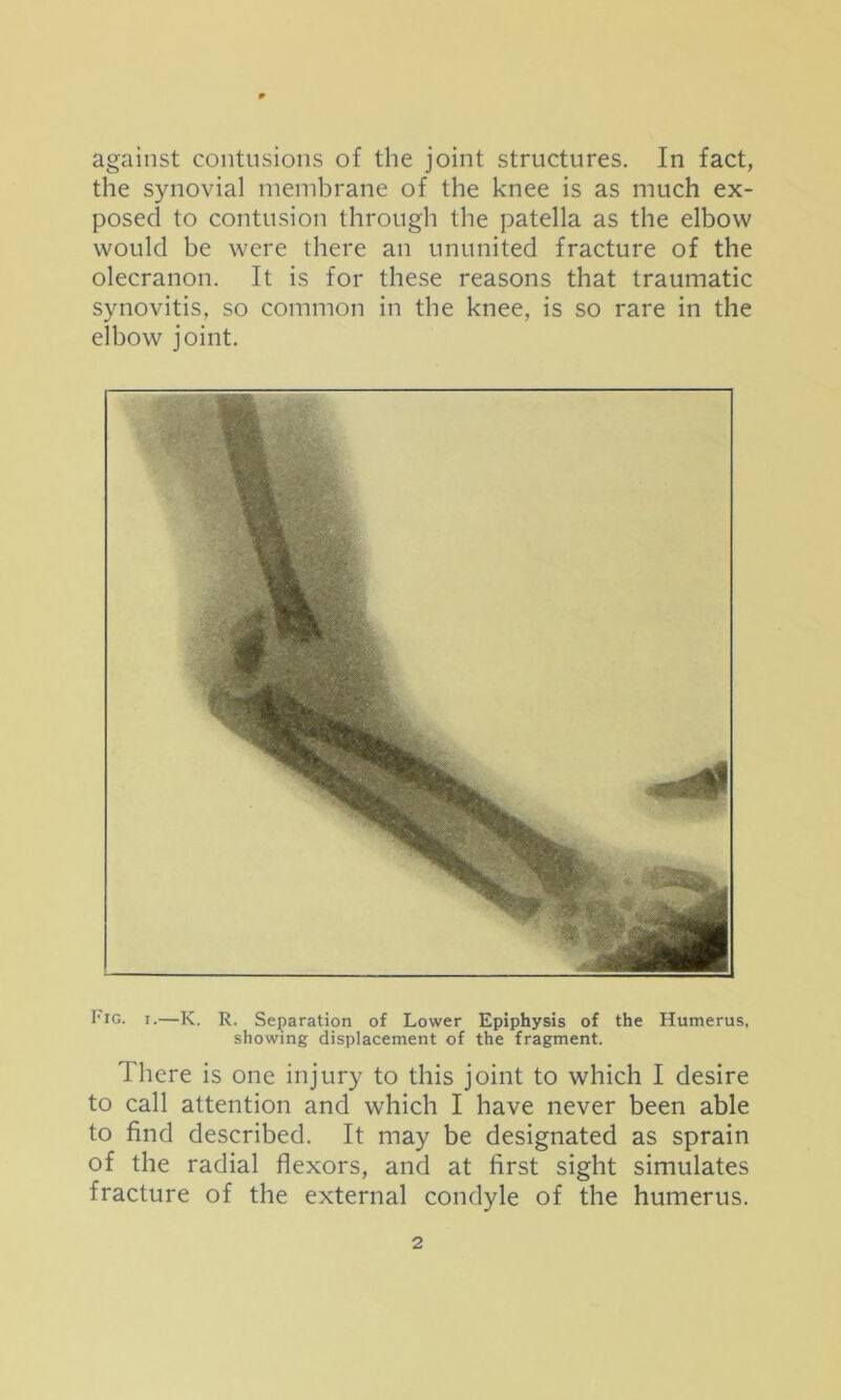 against contusions of the joint structures. In fact, the synovial membrane of the knee is as much ex- posed to contusion through the patella as the elbow would be were there an ununited fracture of the olecranon. It is for these reasons that traumatic synovitis, so common in the knee, is so rare in the elbow joint. I'lG. I.—K. R. Separation of Lower Epiphysis of the Humerus, showing displacement of the fragment. There is one injury to this joint to which I desire to call attention and which I have never been able to find described. It may be designated as sprain of the radial flexors, and at first sight simulates fracture of the external condyle of the humerus.