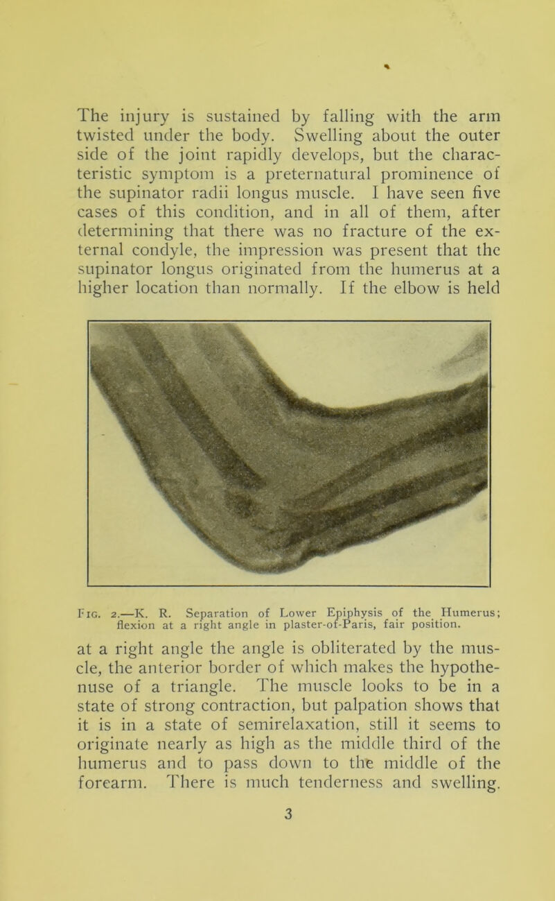 % The injury is sustained by falling with the arm twisted under the body. Swelling about the outer side of the joint rapidly develops, but the charac- teristic symptom is a preternatural prominence of the supinator radii longus muscle. I have seen five cases of this condition, and in all of them, after determining that there was no fracture of the ex- ternal condyle, the impression was present that the supinator longus originated from the humerus at a higher location than normally. If the elbow is held Fig. 2.—K. R. Separation of Lower Epiphysis of the Humerus; flexion at a right angle in plaster-of-Paris, fair position. at a right angle the angle is obliterated by the mus- cle, the anterior border of which makes the hypothe- nuse of a triangle. The muscle looks to be in a state of strong contraction, but palpation shows that it is in a state of semirelaxation, still it seems to originate nearly as high as the middle third of the humerus and to pass down to the middle of the forearm. There is much tenderness and swelling.