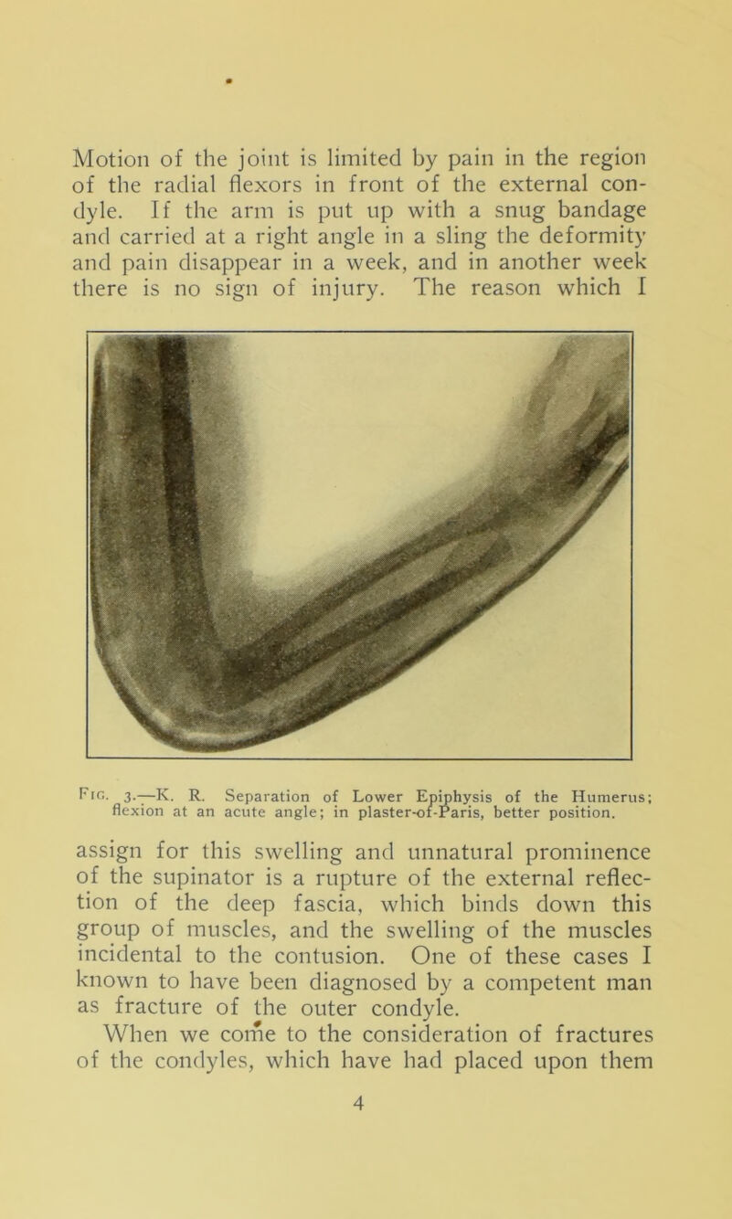 Motion of the joint is limited by pain in the region of the radial flexors in front of the external con- dyle. If the arm is put up with a snug bandage and carried at a right angle in a sling the deformity and pain disappear in a week, and in another week there is no sign of injury. The reason which I Fio. 3.—K. R. Separation of Lower Ep^hysis of the Humerus; flexion at an acute angle; in plaster-oi-Paris, better position. assign for this swelling and unnatural prominence of the supinator is a rupture of the external reflec- tion of the deep fascia, which binds down this group of muscles, and the swelling of the muscles incidental to the contusion. One of these cases I known to have been diagnosed by a competent man as fracture of the outer condyle. When we come to the consideration of fractures of the condyles, which have had placed upon them