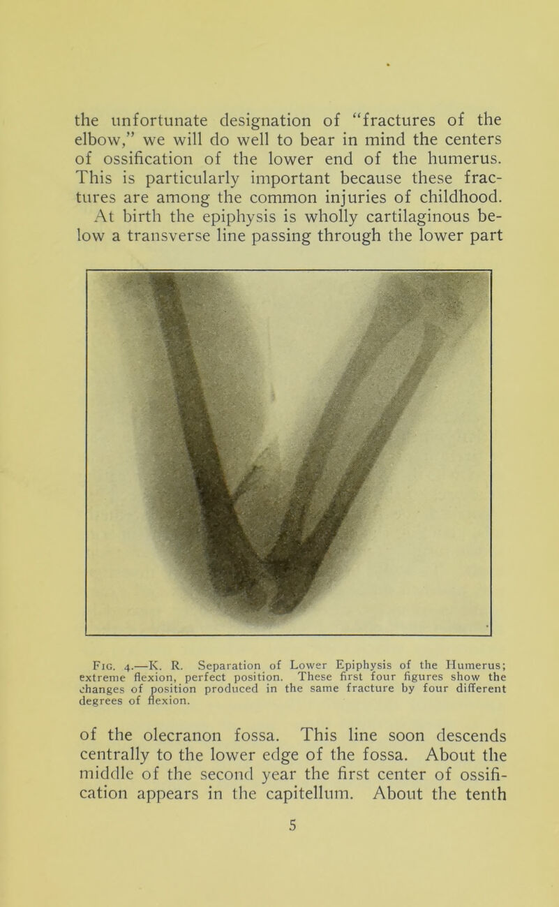 the unfortunate designation of “fractures of the elbow,” we will do well to bear in mind the centers of ossification of the lower end of the humerus. This is particularly important because these frac- tures are among the common injuries of childhood. At birth the epiphysis is wholly cartilaginous be- low a transverse line passing through the lower part Fig. 4.—K. R. Separation of Lower Epiphysis of the Humerus; extreme flexion, perfect position. These first four figures show the changes of position produced in the same fracture by four different degrees of flexion. of the olecranon fossa. This line soon descends centrally to the lower edge of the fossa. About the middle of the second year the first center of ossifi- cation appears in the capitellum. About the tenth