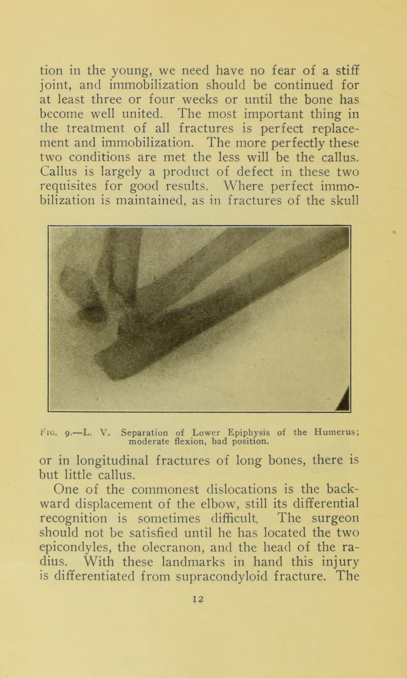 tion in the young, we need have no fear of a stiff joint, and immobilization should be continued for at least three or four weeks or until the bone has become well united. The most important thing in the treatment of all fractures is perfect replace- ment and immobilization. The more perfectly these two conditions are met the less will be the callus. Callus is largely a product of defect in these two requisites for good results. Where perfect immo- bilization is maintained, as in fractures of the skull I'lG. 9.—L. V. Separation of Lower Epiphysis of the Humerus; moderate flexion, bad position. or in longitudinal fractures of long bones, there is but little callus. One of the commonest dislocations is the back- ward displacement of the elbow, still its differential recognition is sometimes difficult. The surgeon should not be satisfied until he has located the two epicondyles, the olecranon, and the head of the ra- dius. With these landmarks in hand this injury is differentiated from supracondyloid fracture. The