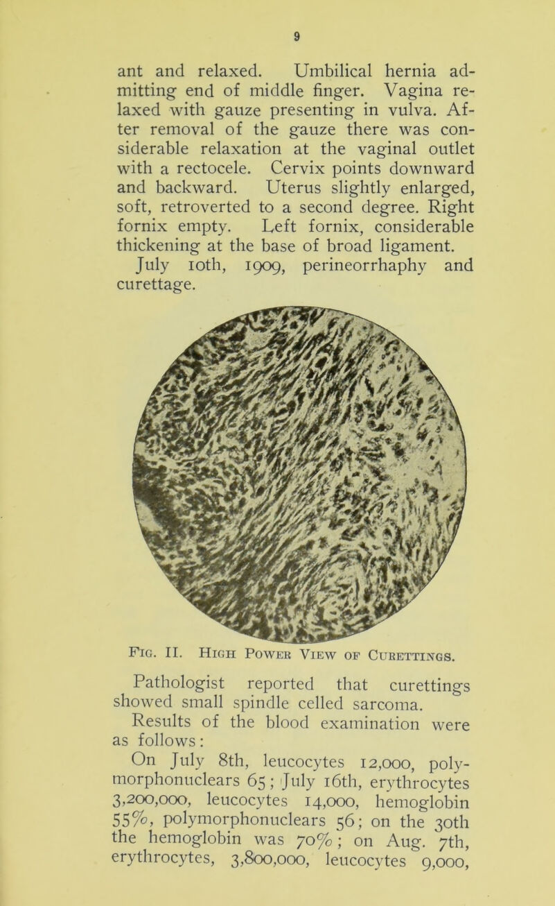 ant and relaxed. Umbilical hernia ad- mitting end of middle finger. Vagina re- laxed with gauze presenting in vulva. Af- ter removal of the gauze there was con- siderable relaxation at the vaginal outlet with a rectocele. Cervix points downward and backward. Uterus slightly enlarged, soft, retroverted to a second degree. Right fornix empty. Left fornix, considerable thickening at the base of broad ligament. July ioth, 1909, perineorrhaphy and curettage. Fig. II. High Power View of Curettings. Pathologist reported that curettings showed small spindle celled sarcoma. Results of the blood examination were as follows: On July 8th, leucocytes 12,000, poly- morphonuclears 65; July 16th, erythrocytes 3,200,000, leucocytes 14,000, hemoglobin 55%, polymorphonuclears 56; on the 30th the hemoglobin was 70%; on Aug. 7th, erythrocytes, 3,800,000, leucocytes 9,000,