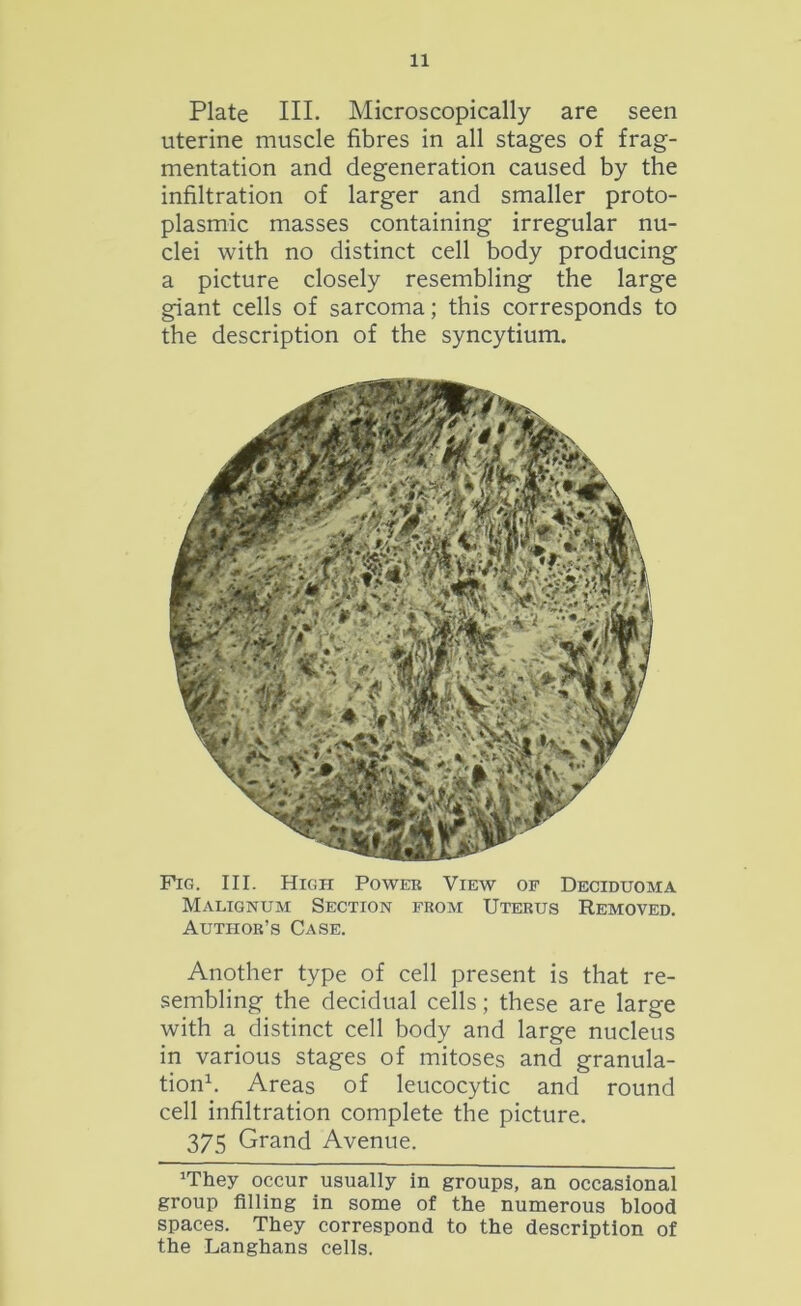 Plate III. Microscopically are seen uterine muscle fibres in all stages of frag- mentation and degeneration caused by the infiltration of larger and smaller proto- plasmic masses containing irregular nu- clei with no distinct cell body producing a picture closely resembling the large giant cells of sarcoma; this corresponds to the description of the syncytium. Fig. III. High Power View of Deciduoma Malignum Section from Uterus Removed. Author’s Case. Another type of cell present is that re- sembling the decidual cells; these are large with a distinct cell body and large nucleus in various stages of mitoses and granula- tion1. Areas of leucocytic and round cell infiltration complete the picture. 375 Grand Avenue. ‘They occur usually in groups, an occasional group filling in some of the numerous blood spaces. They correspond to the description of the Langhans cells.