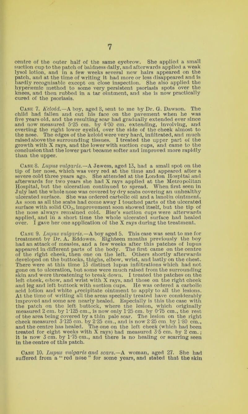 centre of the outer half of the same eyebrow. She applied a small suction cup to the patch of baldness dally, and afterwards applied a weak lysol lotion, and in a few weeks several new hairs appeared on the patch, and at the time of writing it had more or less disappeared and is hardly recognisable except on close inspection. She also applied the hypersDmic method to some very persistent psoriasis spots over the knees, and then rubbed in a tar ointment, and she is now practically cured of the psoriasis. Case 7. Keloid.—A boy, aged 8, sent to me by Dr. G. Dawson. The child had fallen and cut his face on the pavement when he was five years old. and the resulting scar had gradually extended ever since and now measured 5‘25 cm. by 4‘50 cm. extending, involving, and everting the right lower eyelid, over the side of the cheek almost to the nose. The edges of the keloid were very hard, infiltrated, and much raised above the surrounding tissues. I treated the upper part of the growth with X rays, and the lower with suction cups, and came to the conclusion that the lower part became softer and improved more rapidly than the upper. Case 8. Lupus vulgaris.—A Jewess, aged 13. had a small spot on the tip of her nose, which was very red at the time and appeared after a severe cold three years ago. She attended at the London Hospital and afterwards for two years she had X rays applied at the Metropolitan Hospital, but the ulceration continued to spread. When first seen in July la.st the whole nose was covered by dry scabs covering an unhealthy ulcerated surface. She was ordered carbolic oil and a lanolin ointment. As soon as all the scabs had come away I touched parts of the ulcerated surface with solid CO2, improvement soon showed itself, but the tip of the nose always remained cold. Bier’s suction cups were afterwards applied, and in a short time the whole ulcerated surface had healed over. I gave her one application of the X rays during the treatment. Case 9. Lupus vulgaris.—A boy aged 5. This case was sent to me for treatment by Dr. A. Kdeiowes. Kighteen months previously the boy had an attack of measles, and a few weeks after this patches of lupus appeared in different parts of the body. The first came on the centre of the right cheek, then one on the left. Others shortly afterwards developed on the buttocks, thighs, elbow, wrist, and lastly on the chest. There were at this time 13 distinct lupus infiltrations which had not gone on to ulceration, but some were much raised from the surrounding skin and were threatening to break down. I treated the patches on the left cheek, eibow, and wrist with X rays, and those on the right cheek and leg and left buttock with suction cups. He was ordered a carbolic acid lotion and white precipitate ointment to apply to all the lesions. At the time of writing all the areas specially treated have considerably improved and some are nearly healed. Especially is this the case with the patch on the left buttock, where the lesion, which originally measured 2 cm. by 1T25 cm., is now only 1‘25 cm. by 0'75 cm., the rest of the area being covered by a thin pale scar. The lesion on the right cheek measured 3T25 cm. by 2’25 cm., and is now 2'25 cm by 1'80 cm., and the centre has healed. The one on the left cheek (which had been treated for eight weeks with X rays) had measured 3 5 cm. by 2 cm.; it is now 3 cm. by l'75cm., and there is no healing or scarring seen in the centre of this patch. Case 10. Lupus vulgaris and scars.—A. woman, aged 27. She had suffered from a “red nose” for some years, and stated that the skin