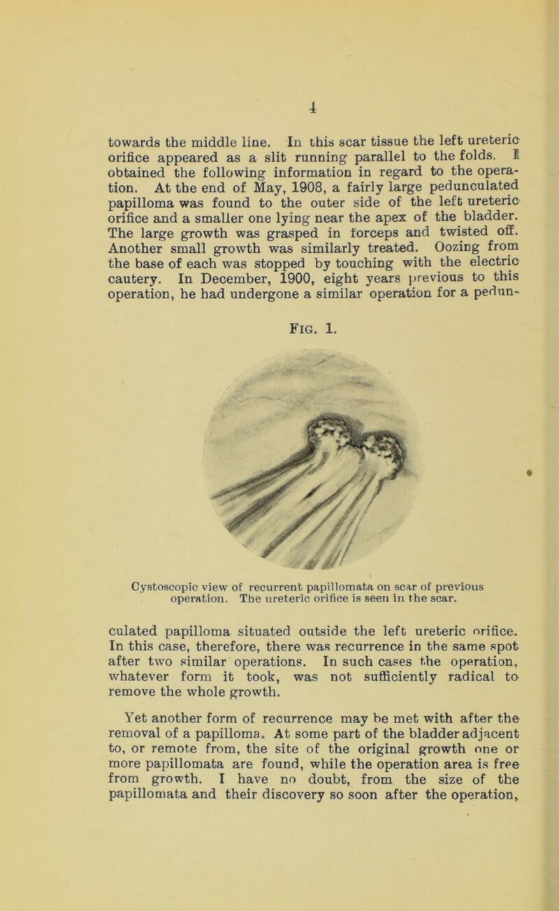 towards the middle line. In this scar tissue the left ureteric orifice appeared as a slit running parallel to the folds. 11 obtained the following information in regard to the opera- tion. At the end of May, 1908, a fairly large pedunculated papilloma was found to the outer side of the left ureteric orifice and a smaller one lying near the apex of the bladder. The large growth was grasped in forceps and twisted off. Another small growth was similarly treated. Oozing from the base of each was stopped by touching with the electric cautery. In December, 1900, eight years previous to this operation, he had undergone a similar operation for a pedun- Cystoscopic view of recurrent papillomata on scar of previous operation. The ureteric orifice is seen in the scar. culated papilloma situated outside the left ureteric orifice. In this case, therefore, there was recurrence in the same spot after two similar operations. In such cases the operation, whatever form it took, was not sufficiently radical to remove the whole growth. Yet another form of recurrence may be met with after the removal of a papilloma. At some part of the bladder adjacent to, or remote from, the site of the original growth one or more papillomata are found, while the operation area is free from growth. I have no doubt, from the size of the papillomata and their discovery so soon after the operation. Fig. 1