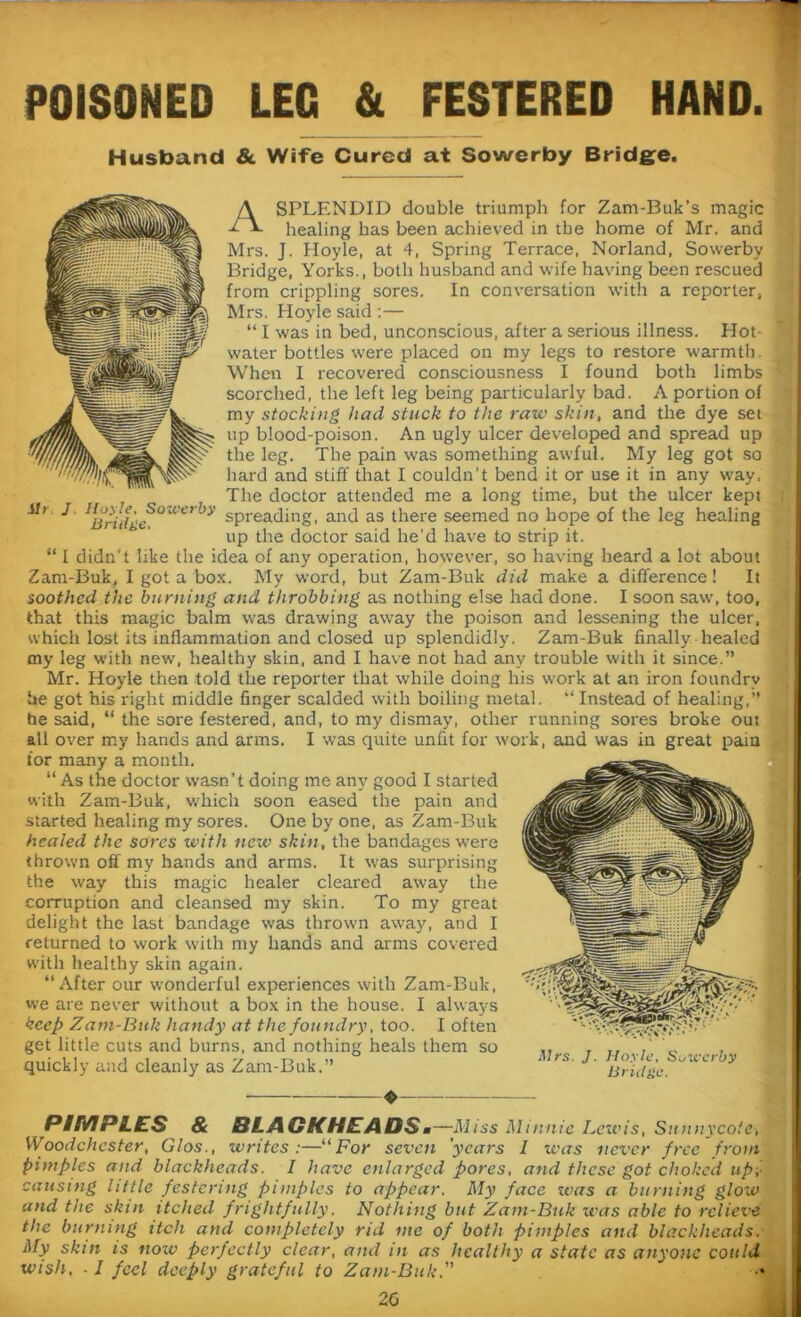 POISONED LEG & FESTERED HAND. Husband & Wife Cured at Sowerby Bridge. A SPLENDID double triumph for Zam-Buk’s magic healing has been achieved in the home of Mr. and Mrs. J. Hoyle, at 4, Spring Terrace, Norland, Sowerby Bridge, Yorks., both husband and wife having been rescued from crippling sores. In conversation with a reporter, Mrs. Hoyle said :— “ I was in bed, unconscious, after a serious illness. Hot- water bottles were placed on my legs to restore warmth. When I recovered consciousness I found both limbs scorched, the left leg being particularly bad. A portion of my stocking had stuck to the raw skin, and the dye set up blood-poison. An ugly ulcer developed and spread up the leg. The pain was something awful. My leg got so hard and stiff that I couldn't bend it or use it in any way. The doctor attended me a long time, but the ulcer kept spreading, and as there seemed no hope of the leg healing up the doctor said he’d have to strip it. “ I didn't like the idea of any operation, however, so having heard a lot about Zam-Buk, I got a box. My word, but Zam-Buk did make a difference! It soothed the burning and throbbing as nothing else had done. I soon saw, too, that this magic balm was drawing away the poison and lessening the ulcer, which lost its inflammation and closed up splendidly. Zam-Buk finally healed my leg with new, healthy skin, and I have not had any trouble with it since.” Mr. Hoyle then told the reporter that while doing his work at an iron foundry he got his right middle finger scalded with boiling metal. “ Instead of healing,” he said, “ the sore festered, and, to my dismay, other running sores broke out all over my hands and arms. I was quite unfit for work, and was in great pain for many a month. “ As the doctor wasn’t doing me any good I started with Zam-Buk, which soon eased the pain and started healing my sores. One by one, as Zam-Buk healed the sores with new skin, the bandages were thrown off my hands and arms. It was surprising the wray this magic healer cleared away the corruption and cleansed my skin. To my great delight the last bandage was thrown away, and I returned to work with my hands and arms covered with healthy skin again. “After our wonderful experiences with Zam-Buk, we are never without a box in the house. I always keep Zam-Buk handy at the foundry, too. I often get little cuts and burns, and nothing heals them so quickly and cleanly as Zam-Buk.” ♦ *11 PIMPLES & BLACKHEADS. —Miss Minnie Lewis, Sunnycote, Woodchcster, Glos., writes:—uFor seven years I was never free from pimples and blackheads. I have enlarged pores, and these got choked up;- causing little festering pimples to appear. My face zvas a burning glow and the skin ttched frightfully. Nothing but Zam-Buk was able to relieve the burning itch and completely rid me of both pimples and blackheads. My skin is nozv perfectly clear, and in as healthy a state as anyone could wish. ■ I feel deeply grateful to Zam-Buk. ” •» 20 ilr J Hoyle. Sozvcrby Bridge.