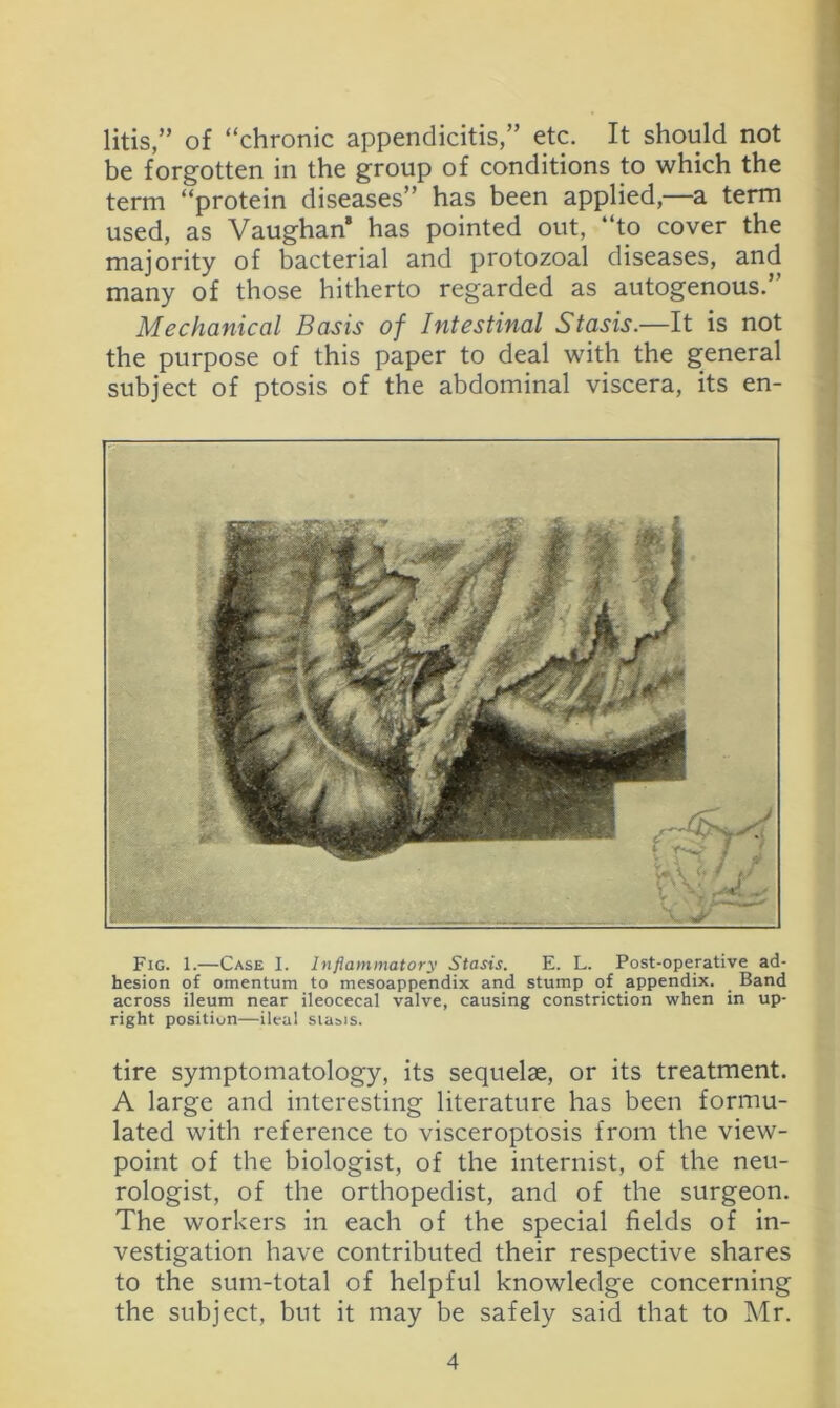 litis,” of “chronic appendicitis,” etc. It should not be forgotten in the group of conditions to which the term “protein diseases” has been applied,—a term used, as Vaughan* has pointed out, “to cover the majority of bacterial and protozoal diseases, and many of those hitherto regarded as autogenous.” Mechanical Basis of Intestinal Stasis.—It is not the purpose of this paper to deal with the general subject of ptosis of the abdominal viscera, its en- Fig. 1.—Case I. Inflammatory Stasis. E. L. Post-operative ad- hesion of omentum to mesoappendix and stump of appendix. Band across ileum near ileocecal valve, causing constriction when in up- right position—ileal sia»is. tire symptomatology, its sequelae, or its treatment. A large and interesting literature has been formu- lated with reference to visceroptosis from the view- point of the biologist, of the internist, of the neu- rologist, of the orthopedist, and of the surgeon. The workers in each of the special fields of in- vestigation have contributed their respective shares to the sum-total of helpful knowledge concerning the subject, but it may be safely said that to Mr.