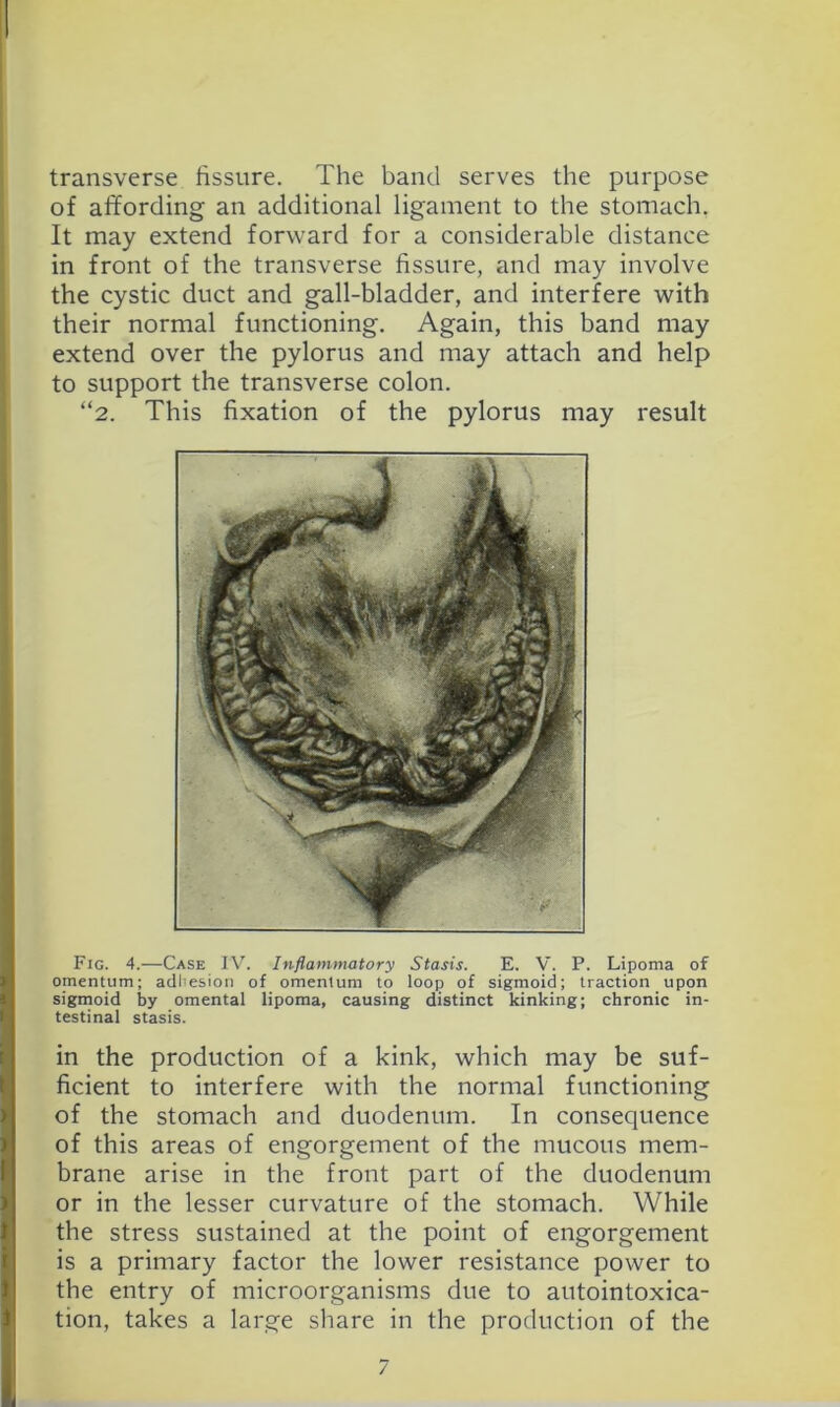 transverse fissure. The band serves the purpose of affording an additional ligament to the stomach. It may extend forward for a considerable distance in front of the transverse fissure, and may involve the cystic duct and gall-bladder, and interfere with their normal functioning. Again, this band may extend over the pylorus and may attach and help to support the transverse colon. “2. This fixation of the pylorus may result Fig. 4.—Case IV. Inflammatory Stasis. E. V. P. Lipoma of omentum; adhesion of omentum to loop of sigmoid; traction upon sigmoid by omental lipoma, causing distinct kinking; chronic in- testinal stasis. in the production of a kink, which may be suf- ficient to interfere with the normal functioning of the stomach and duodenum. In consequence of this areas of engorgement of the mucous mem- brane arise in the front part of the duodenum or in the lesser curvature of the stomach. While the stress sustained at the point of engorgement is a primary factor the lower resistance power to the entry of microorganisms due to autointoxica- tion, takes a large share in the production of the /