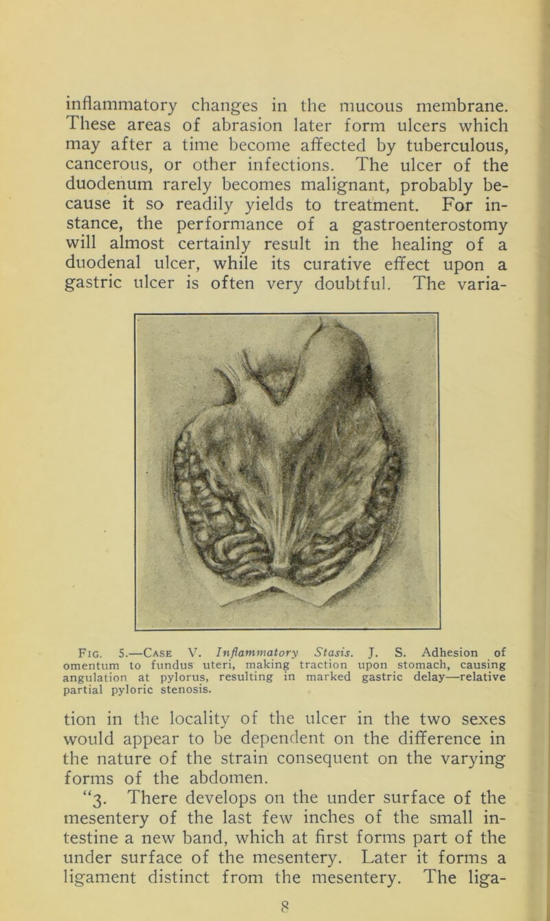 inflammatory changes in the mucous membrane. These areas of abrasion later form ulcers which may after a time become affected by tuberculous, cancerous, or other infections. The ulcer of the duodenum rarely becomes malignant, probably be- cause it so readily yields to treatment. For in- stance, the performance of a gastroenterostomy will almost certainly result in the healing of a duodenal ulcer, while its curative effect upon a gastric ulcer is often very doubtful. The varia- Fig. 5.—Case Inflammatory Stasis. J. S. Adhesion of omentum to fundus uteri, making traction upon stomach, causing angulation at pylorus, resulting in marked gastric delay—relative partial pyloric stenosis. tion in the locality of the ulcer in the two sexes would appear to be dependent on the difference in the nature of the strain consequent on the varying forms of the abdomen. “3. There develops on the under surface of the mesentery of the last few inches of the small in- testine a new band, which at first forms part of the under surface of the mesentery. Later it forms a ligament distinct from the mesentery. The liga-