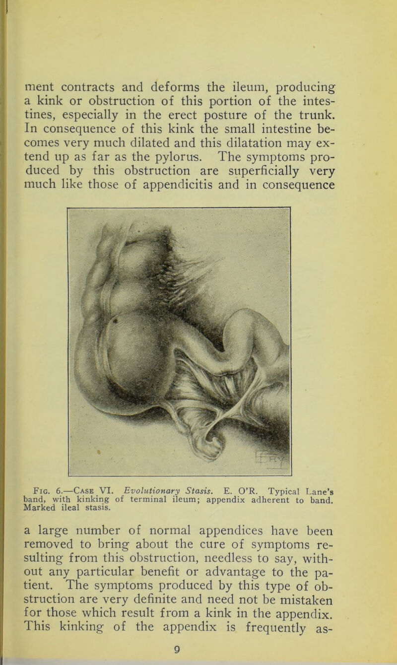 ment contracts and deforms the ileum, producing ; a kink or obstruction of this portion of the intes- tines, especially in the erect posture of the trunk. , In consequence of this kink the small intestine be- ) comes very much dilated and this dilatation may ex- I tend up as far as the pylorus. The symptoms pro- I duced by this obstruction are superficially very ;! much like those of appendicitis and in consequence Fig. 6.—Case VI. Evolutionary Stasis. E. O’R. Typical Lane’s band, with kinking of terminal ileum; appendix adherent to band. Marked ileal stasis. a large number of normal appendices have been removed to bring about the cure of symptoms re- sulting from this obstruction, needless to say, with- out any particular benefit or advantage to the pa- tient. The symptoms produced by this type of ob- struction are very definite and need not be mistaken for those which result from a kink in the appendix. This kinking of the appendix is frequently as-