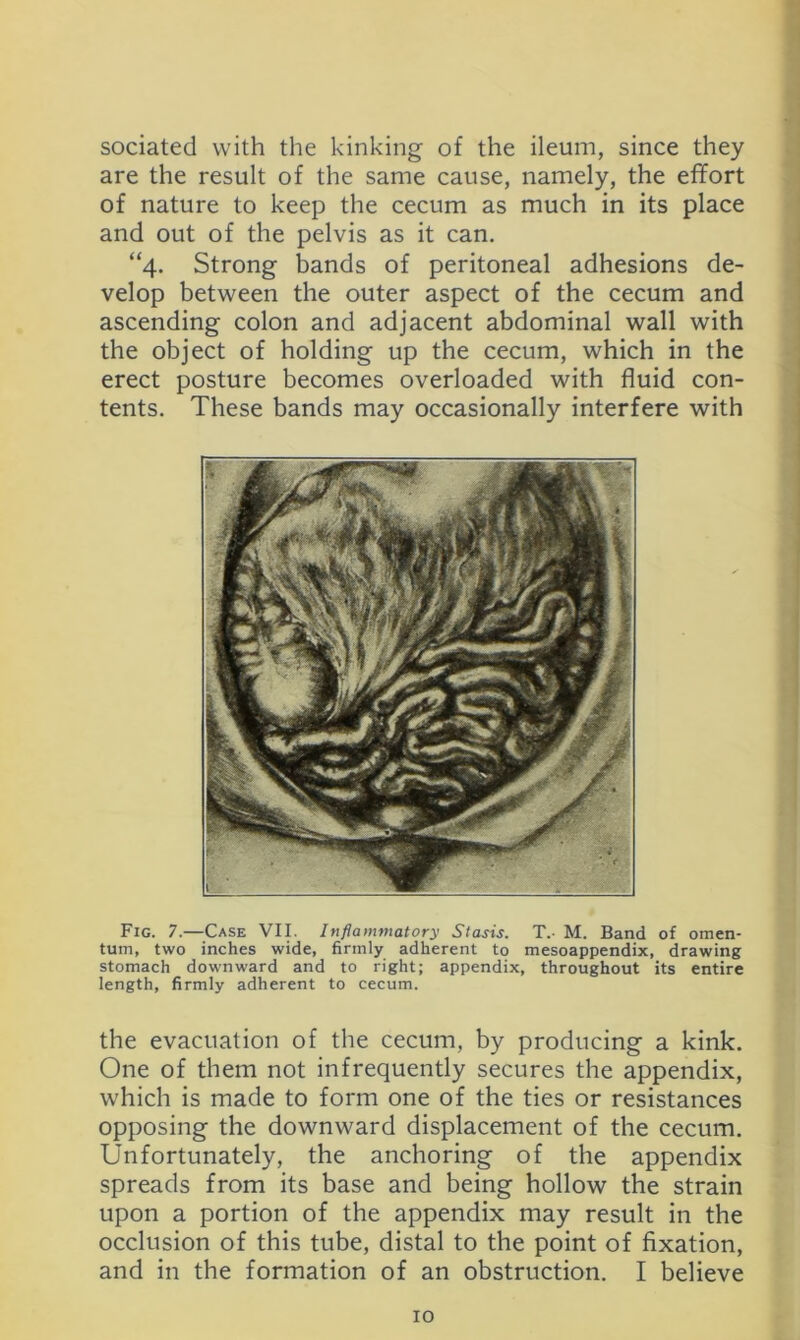sociated with the kinking of the ileum, since they are the result of the same cause, namely, the effort of nature to keep the cecum as much in its place and out of the pelvis as it can. “4. Strong bands of peritoneal adhesions de- velop between the outer aspect of the cecum and ascending colon and adjacent abdominal wall with the object of holding up the cecum, which in the erect posture becomes overloaded with fluid con- tents. These bands may occasionally interfere with Fig. 7.—Case VII. Inflammatory Stasis. T.- M. Band of omen- tum, two inches wide, firmly adherent to mesoappendix, drawing stomach downward and to right; appendix, throughout its entire length, firmly adherent to cecum. the evacuation of the cecum, by producing a kink. One of them not infrequently secures the appendix, which is made to form one of the ties or resistances opposing the downward displacement of the cecum. Unfortunately, the anchoring of the appendix spreads from its base and being hollow the strain upon a portion of the appendix may result in the occlusion of this tube, distal to the point of fixation, and in the formation of an obstruction. I believe