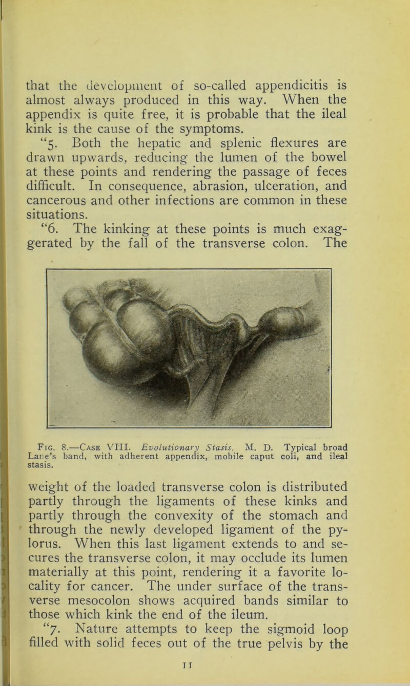 that the clevclupinent of so-called appendicitis is almost always produced in this way. When the appendix is quite free, it is probable that the ileal kink is the cause of the symptoms. “5. Both the hepatic and splenic flexures are drawn upwards, reducing the lumen of the bowel at these points and rendering the passage of feces difficult. In consequence, abrasion, ulceration, and cancerous and other infections are common in these situations. “6. The kinking at these points is much exag- gerated by the fall of the transverse colon. The Fig. 8.—Case VIII. Evolutionary Stasis. M. D. Typical broad L Lane’s band, with adherent appendix, mobile caput coli, and ileal i stasis. t I I I weight of the loaded transverse colon is distributed partly through the ligaments of these kinks and partly through the convexity of the stomach and through the newly developed ligament of the py- lorus, When this last ligament extends to and se- cures the transverse colon, it may occlude its lumen materially at this point, rendering it a favorite lo- cality for cancer. The under surface of the trans- verse mesocolon shows acquired bands similar to those which kink the end of the ileum. “7. Nature attempts to keep the sigmoid loop filled with solid feces out of the true pelvis by the