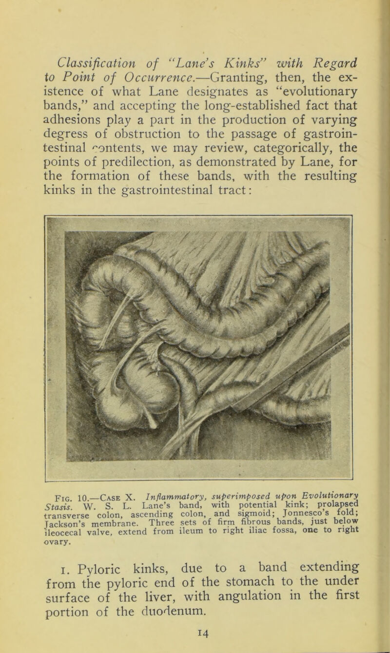 Classification of “Lane’s Kinks” with Regard to Point of Occurrence.—Granting, then, the ex- istence of what Lane designates as “evolutionary bands,” and accepting the long-established fact that adhesions play a part in the production of varying degress of obstruction to the passage of gastroin- testinal contents, we may review, categorically, the points of predilection, as demonstrated by Lane, for the formation of these bands, with the resulting kinks in the gastrointestinal tract: PiG_ 10. Case X. Inflammatory, superimposed upon Evolutionary Stasis. W. S. L. Lane’s band, with potential kink; prolapsed transverse colon, ascending colon, and sigmoid; Jonnesco’s fold; Jackson’s membrane. Three sets of firm fibrous bands, just below ileocecal valve, extend from ileum to right iliac fossa, one to right ovary. I. Pyloric kinks, due to a band extending from the pyloric end of the stomach to the under surface of the liver, with angulation in the first portion of the duodenum.