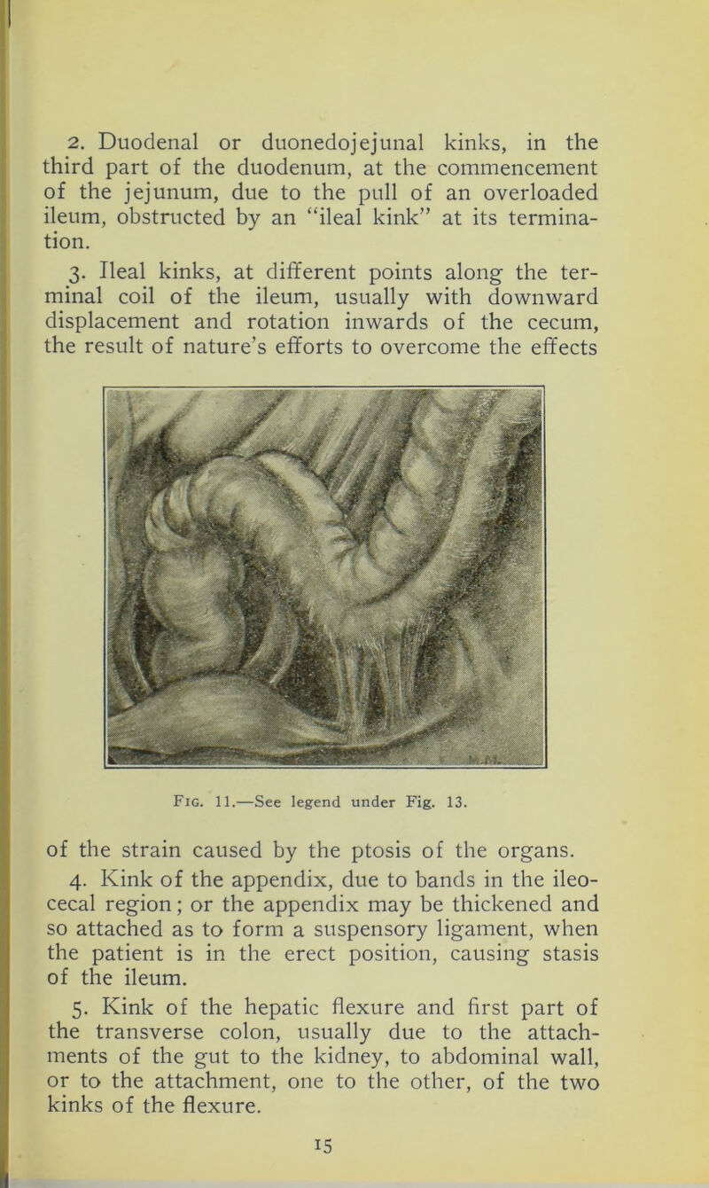 2. Duodenal or duonedojejuiial kinks, in the third part of the duodenum, at the commencement of the jejunum, due to the pull of an overloaded ileum, obstructed by an “ileal kink” at its termina- tion. 3. Ileal kinks, at different points along the ter- minal coil of the ileum, usually with downward displacement and rotation inwards of the cecum, the result of nature’s efforts to overcome the effects Fig. 11.—See legend under Fig. 13. of the Strain caused by the ptosis of the organs. 4. Kink of the appendix, due to bands in the ileo- cecal region; or the appendix may be thickened and so attached as to form a suspensory ligament, when the patient is in the erect position, causing stasis of the ileum. 5. Kink of the hepatic flexure and first part of the transverse colon, usually due to the attach- ments of the gut to the kidney, to abdominal wall, or to the attachment, one to the other, of the two kinks of the flexure.