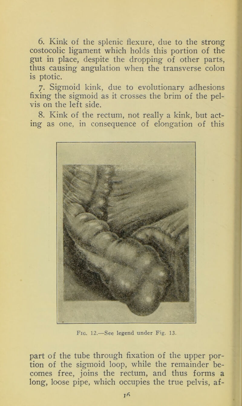 6. Kink of the splenic flexure, due to the strong costocolic ligament which holds this portion of the gut in place, despite the dropping of other parts, thus causing angulation when the transverse colon is ptotic. 7. Sigmoid kink, due to evolutionary adhesions fixing the sigmoid as it crosses the brim of the pel- vis on the left side. 8. Kink of the rectum, not really a kink, but act- ing as one, in consequence of elongation of this Fig. 12.—See legend under Fig. 13. part of the tube through fixation of the upper por- tion of the sigmoid loop, while the remainder be- comes free, joins the rectum, and thus forms a long, loose pipe, which occupies the true pelvis, af-