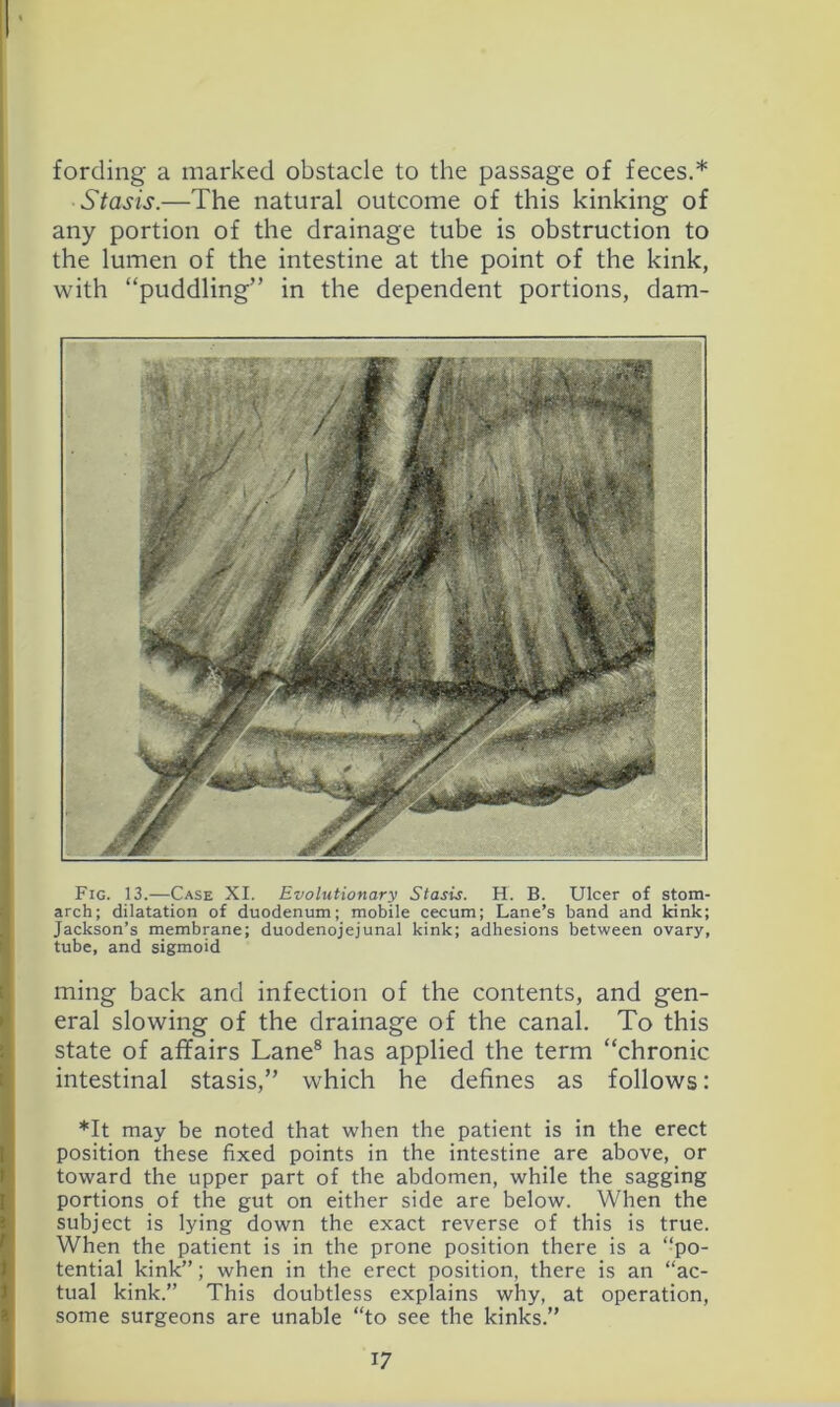 fording a marked obstacle to the passage of feces.* Stasis.—The natural outcome of this kinking of any portion of the drainage tube is obstruction to the lumen of the intestine at the point of the kink, with “puddling” in the dependent portions, dam- Fig. 13.—Case XI. Evolutionary Stasis. H. B. Ulcer of stom- arch; dilatation of duodenum; mobile cecum; Lane’s band and kink; Jackson’s membrane; duodenojejunal kink; adhesions between ovary, tube, and sigmoid ming back and infection of the contents, and gen- eral slowing of the drainage of the canal. To this state of affairs Lane® has applied the term “chronic intestinal stasis,” which he defines as follows: *It may be noted that when the patient is in the erect position these fixed points in the intestine are above, or toward the upper part of the abdomen, while the sagging portions of the gut on either side are below. When the subject is lying down the exact reverse of this is true. When the patient is in the prone position there is a “po- tential kink”; when in the erect position, there is an “ac- tual kink.” This doubtless explains why, at operation, some surgeons are unable “to see the kinks.”