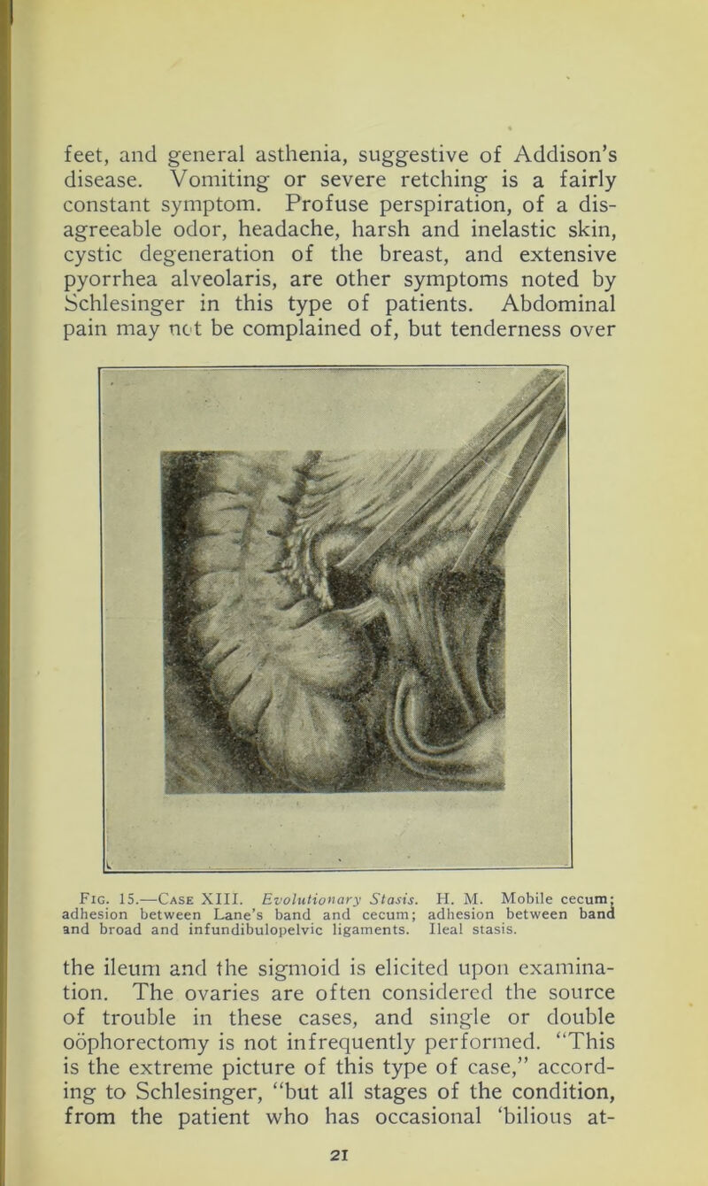 feet, and general asthenia, suggestive of Addison’s disease. Vomiting or severe retching is a fairly constant symptom. Profuse perspiration, of a dis- agreeable odor, headache, harsh and inelastic skin, cystic degeneration of the breast, and extensive pyorrhea alveolaris, are other symptoms noted by Schlesinger in this type of patients. Abdominal pain may net be complained of, but tenderness over Fig. 15.—Case XIII. Evolutionary Stasis. H. M. Mobile cecum: adhesion between Lane’s band and cecum; adhesion between band and broad and infundibulopelvic ligaments. Ileal stasis. the ileum and the sigmoid is elicited upon examina- tion. The ovaries are often considered the source of trouble in these cases, and single or double oophorectomy is not infrequently performed. “This is the extreme picture of this type of case,” accord- ing to Schlesinger, “but all stages of the condition, from the patient who has occasional ‘bilious at-