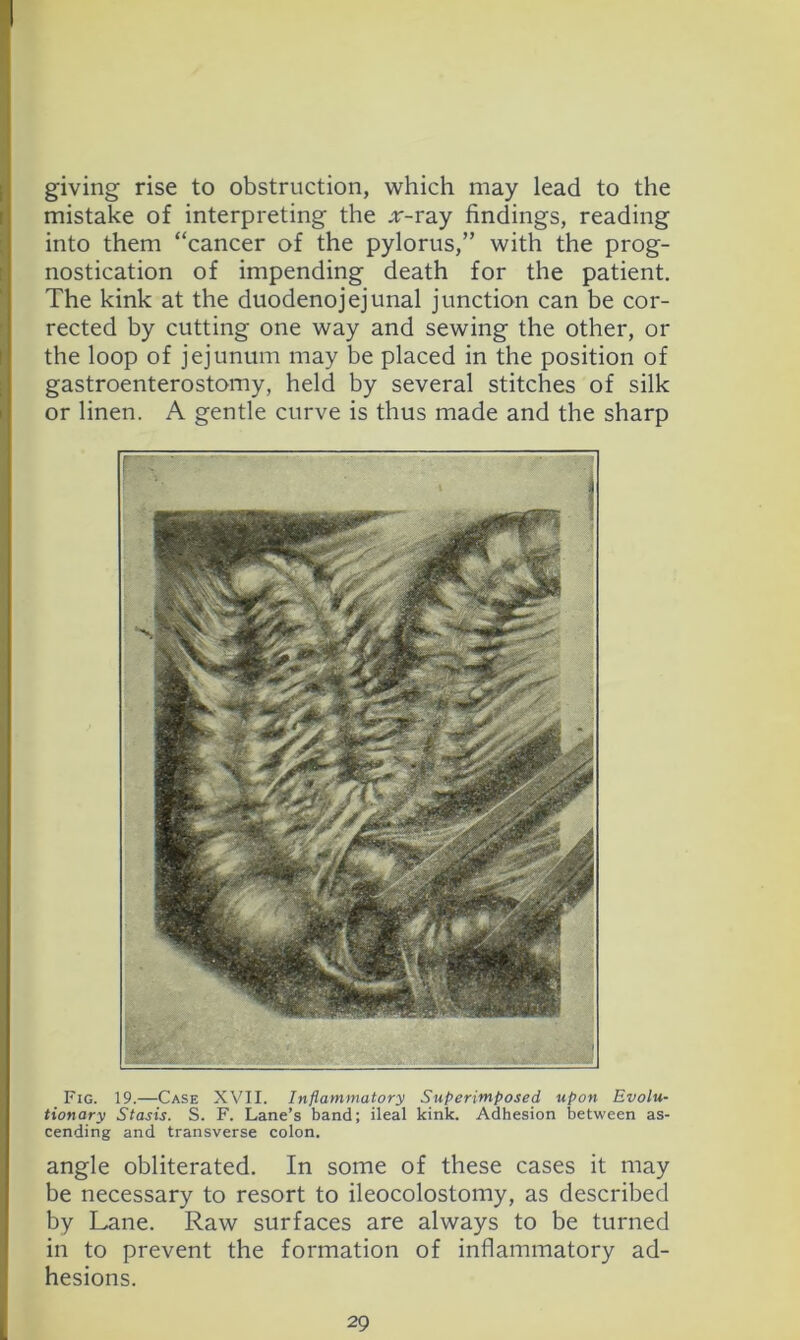 giving rise to obstruction, which may lead to the mistake of interpreting the :r-ray findings, reading into them “cancer of the pylorus,” with the prog- nostication of impending death for the patient. The kink at the duodenojejunal junction can be cor- rected by cutting one way and sewing the other, or the loop of jejunum may be placed in the position of gastroenterostomy, held by several stitches of silk or linen. A gentle curve is thus made and the sharp Fig. 19.—Case XVII. Inflammatory Superimposed upon Evolu- tionary Stasis. S. F. Lane’s band; ileal kink. Adhesion between as- cending and transverse colon. angle obliterated. In some of these cases it may be necessary to resort to ileocolostomy, as described by Lane. Raw surfaces are always to be turned in to prevent the formation of inflammatory ad- hesions.