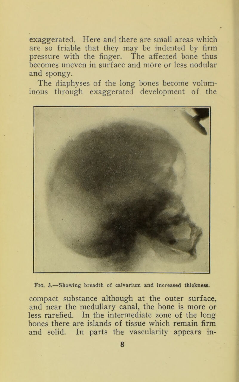 exaggerated. Here and there are small areas which are so friable that they may be indented by firm pressure with the finger. The afifected bone thus becomes uneven in surface and more or less nodular and spongy. The diaphyses of the long bones become volum- inous through exaggerated development of the Fig. 3.—Showing breadth of calvarium and increased thickness. compact substance although at the outer surface, and near the medullary canal, the bone is more or less rarefied. In the intermediate zone of the long bones there are islands of tissue which remain firm and solid. In parts the vascularity appears in-