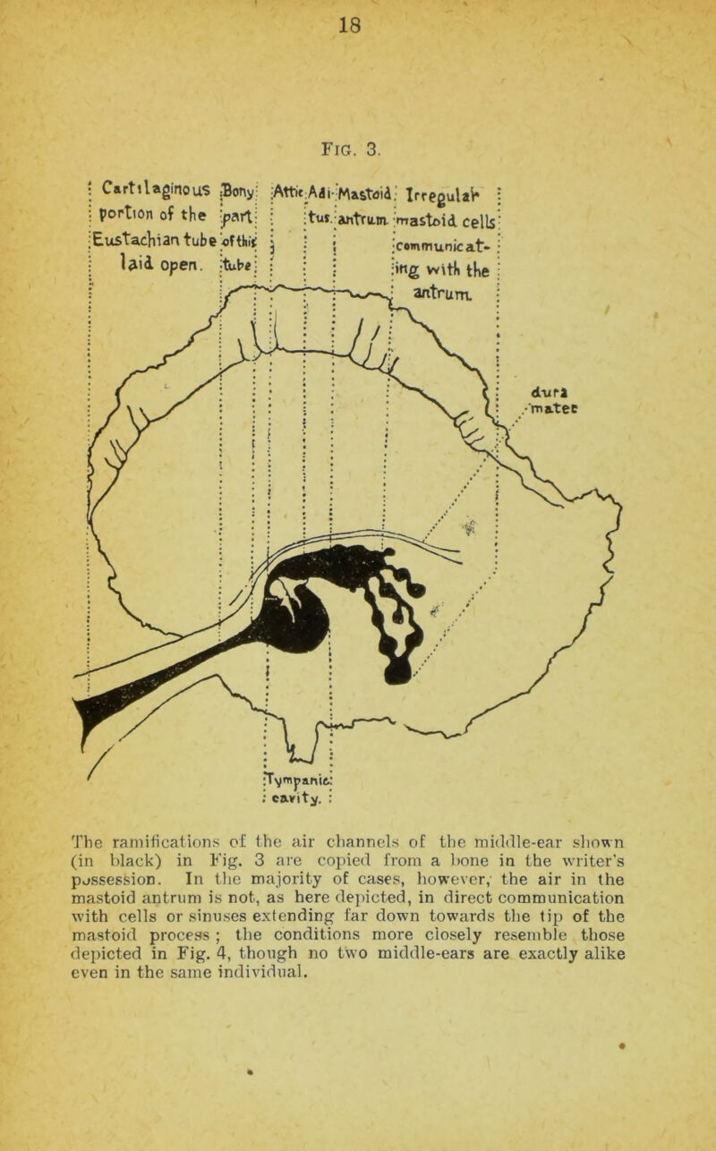 Fig. 3. Cartilaginous portion of the Eustachian tube laid open. Bony: part; tube• : Attic Adi tut Mastoid antrum Irregulah | mastoid cellsr communicat- ; mg with the j antrum. • dura •matec n’vmpanio; ; cavity. : The ramifications of the air channels of the middle-ear shown (in black) in Fig. 3 are copied from a bone in the writer's possession. In the majority of cases, however, the air in the mastoid antrum is not, as here depicted, in direct communication with cells or sinuses extending far down towards the tip of the mastoid process ; the conditions more closely resemble those depicted in Fig. 4, though no two micklle-ears are exactly alike even in the same individual.