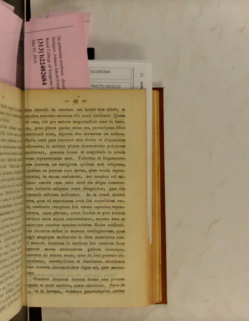 ^tJfisandem materiae naturam sibi quasi vindicaret. Quam ;ib rem, ubi pro ratione magnitudinis uteri in fetni- la, quae plure» partus enixa est, parenchyma illius ntinuari solet, signum eius inventum est nullum, ledia uteri pars consueto erat durior et aliquantum eforinata; in cavitate plures excrescendae polyposae LStiteruut, quarum forma et magnitudo in tabula nea repraesentatae sunt. Tubarum et lingamento- m latorum ne vestigium quidem erat reliquum, f k.quidem ea prorsus cum massa, quae ovaria reprae- rintabat, in unum coaluerant, nec omnino vel mi- ninae canalis cum cavo uteri via aliqua commer- tum habentis reliquiae erant detegendae, quae illa iquando adfuisse indicarent. In ea ovarii sinistri me, quae ad superiorem ossis ilei superficiem ver- at, ossificatio conspicua fuit veram capsulam reprae- jtcntans, aqua plenam, cuius fundus et pars interna jrtione ossea aspera constituebatur, externa vero et aior pars conchae speciem habebat. Huius ossificati- iis circuitus abibat in massam cartilaginosam, quae agis magisque mollescens in dura membrana ova- i evanuit. Incisione in medium hoc ovarium facta ^paruit massa steatomatosa glebosa duriorque, iraeterea ob miram suam, quae in loco persecto ob- uvabatur, crassitudinem et densitatem membrana t' [P muh massam circumcludens digna est, quae merno- „..v< : ’ e i a t*-1 L itur. Ovarium dextrum externa forma erat prorsus quale et tactu mollius, quam sinistrum. Facta in ., ut in laevum, inciaione perpendiculari pariter