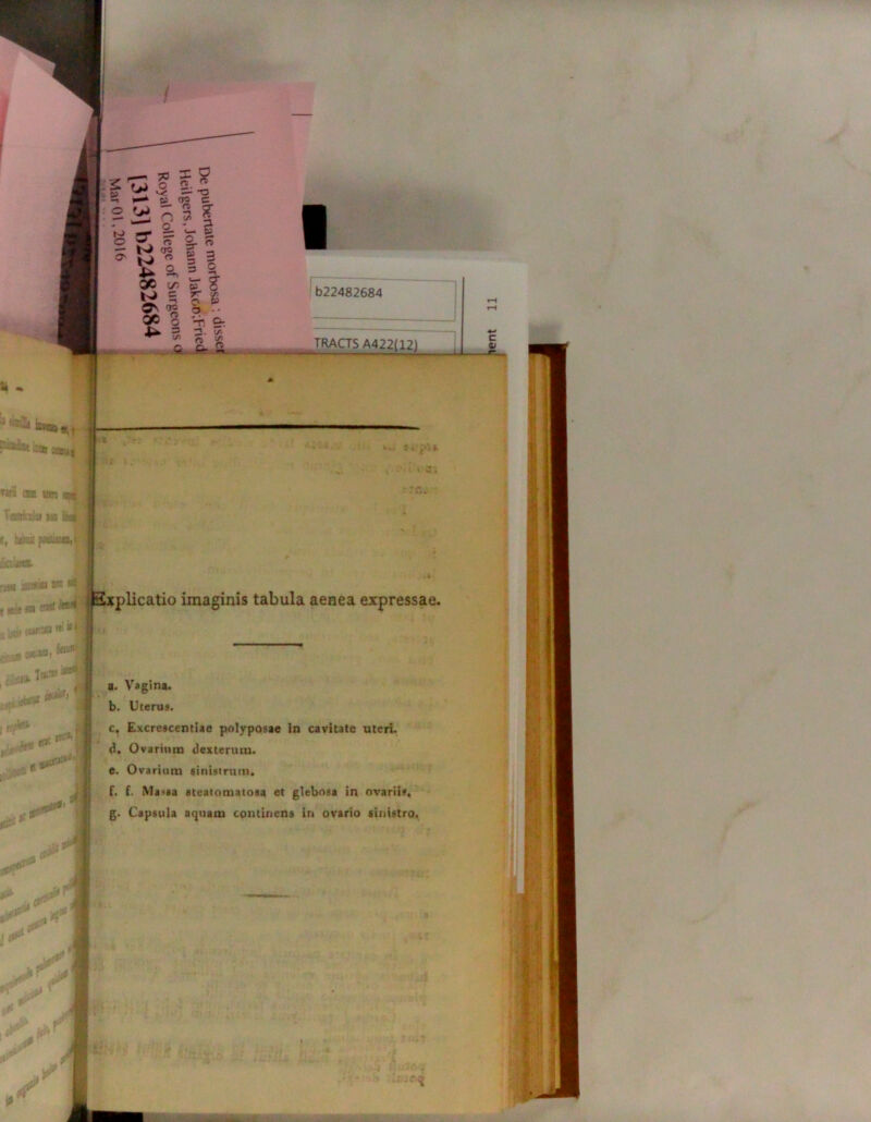 b22482684 . . TRACTS ^ ■ * t TKS CSB MBO Vatrtiia 505 t, iasai paetas», Sakm- ' ■ tjj V* J Explicatio imaginis tabula aenea expressae. a. Vagina. b. Uterus. c. Excrescentiae polyposae in cavitate uteri. d. Ovarium dexterum. e. Ovarium sinistrum. f. f. Massa ateatomatosa et glebosa in ovariis* g. Capsula aquam continens in ovario sinistro^