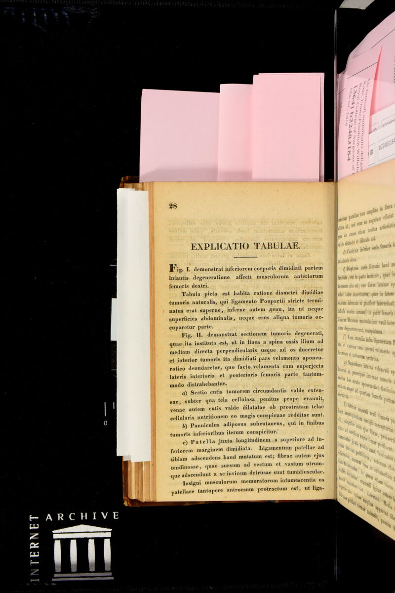 EXPLICATIO TABULAE. * ig. I. demonstrat inferiorem corporis dimidiati partem infantis degeneratione aflecti musculorum anteriorum femoris dextri. Tabula picta est habita ratione diametri dimidiae tumoris naturalis^ cjui ligamento Poupartii stricte termi- natus erat superne, inferne autem genu, ita ut neque superficies abdominalis, neque crus aliqua tumoris oc- cuparetur parte. Fig. H- demonstrat sectionem tumoris degenerati, quae ita instituta est, ut in linea a spina ossis ilium ad mediam directa perpendicularis usque ad os duceretur et interior tumoris ita dimidiati pars velamento aponeu- rotico denudaretur, quo facto velamenta cum superjecta lateris interioris et posterioris femoris parte tantum- modo distrahebantur. a) Sectio cutis tumorem circumdantis valde exten- sae subter qua tela cellulosa penitus prope evanuit, venae autem cutis valde dilatatae ob prostratam telae cellularis nutritionem eo magis conspicuae redditae sunt. b) Panniculus adiposus subcutaneus, qui in finibus tumoris inferioribus iterum conspicitur.' c) Patella juxta longitudinem a superiore ad in- feriorem marginem dimidiata. Ligamentum patellae ad tibiam adseendens haud mutatum est; fibrae autem ejus tendinosae, quae sursum ad rectum et vastum utrum- que adseendunt a se invicem detrusae sunt tumidiusculae. Insigni musculorum memoratorum intumescentia os patellare tantopere antrorsum protractum est, ut liga- , i#, c» -i- ’ colitioiiis flios* f)Diapbis 055« femoris m» inrolDli, deorsum sit» est, w fiiirw sciae latae iiiDfefnntiir, in Itlfff vastum iutemnn et facilem iMerwdoiif, talula nostra sorsum) in parte feiwrls i filirarom masealarinm radi ini*»i ”^?eoeraveruDt, conspicimus, i'» eileiisa vasii in cta et ttorsum ot f‘) intetid, '^'Nae,. fefiencsilo h rettot>.uin r-'- tUDlpfi, fiseic P^ncB, X A 1^ r-