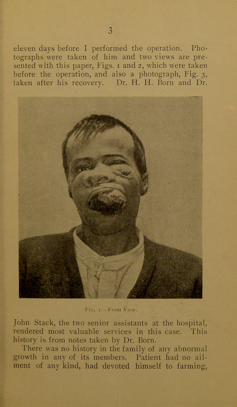eleven clays before I performed the operation. Pho- tographs were taken of him and two views are pre- sented with this paper, Figs, i and 2, which were taken before the operation, and also a photograph, Fig. 3, taken after his recovery. Dr. H. H. Born and Dr. Fig. 1. — Front View. John Stack, the two senior assistants at the hospital, rendered most valuable services in this case. This history is from notes taken by Dr. Born. There was no history in the family of any abnormal growth in any of its members. Patient had no ail- ment of any kind, had devoted himself to farming,